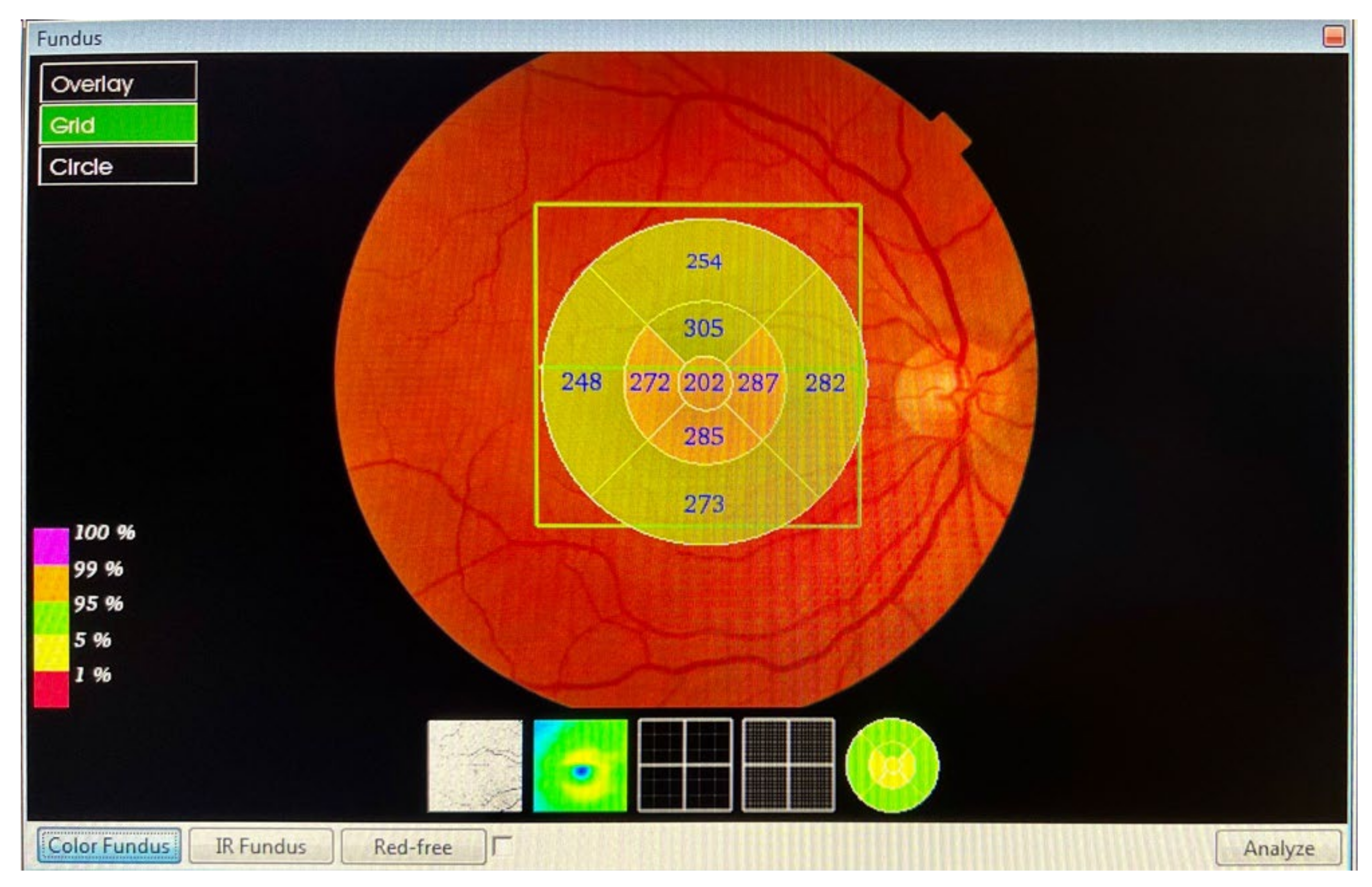 Examples of quadrant-specific retinal nerve fiber layer (RNFL)