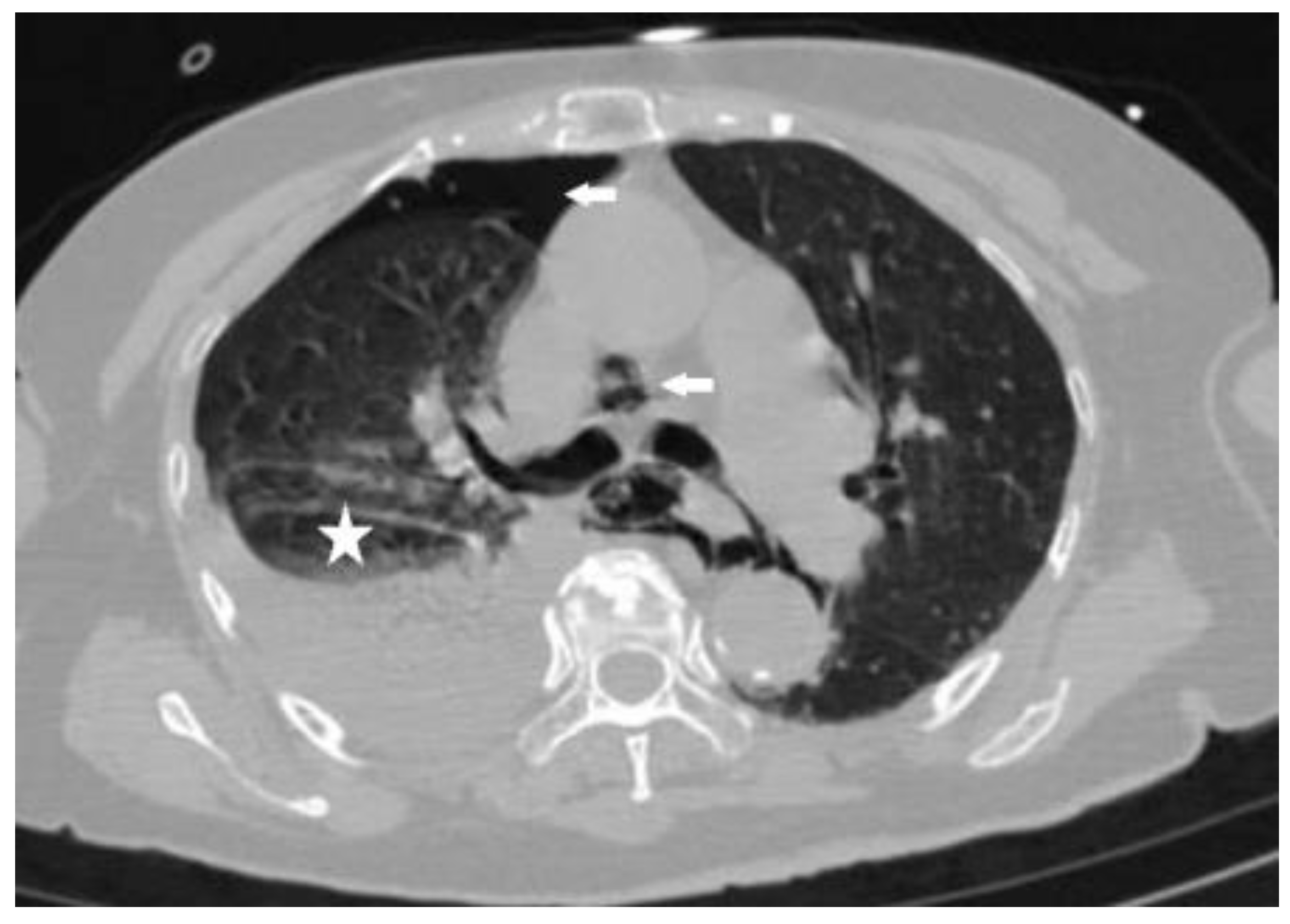 Diagnostics Free FullText Spontaneous Rupture of Esophageal