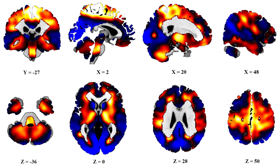 Diagnostics | Free Full-Text | Parkinson’s Disease-Related Brain ...