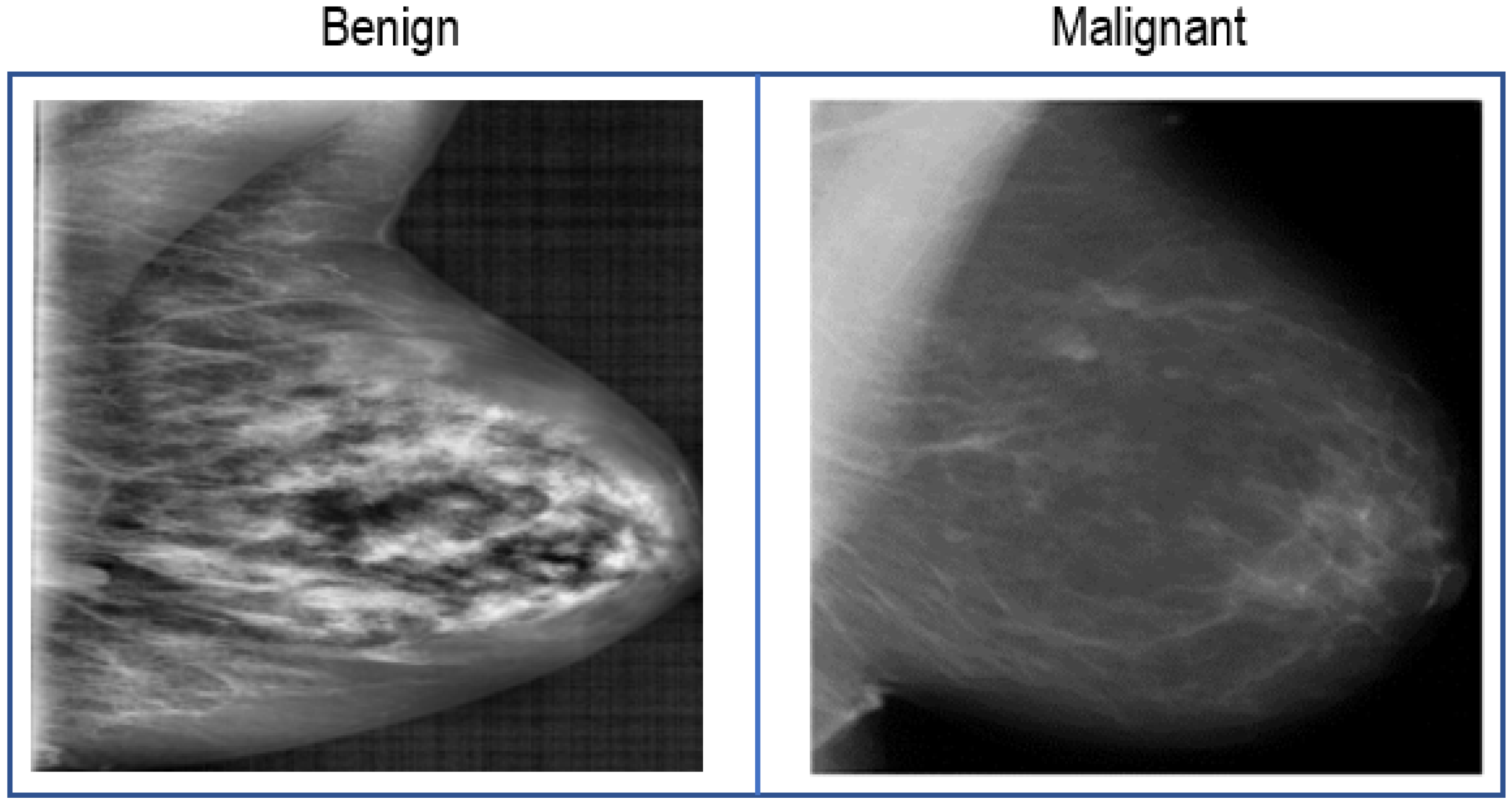 MAMMOGRAPHY  Radiology Key