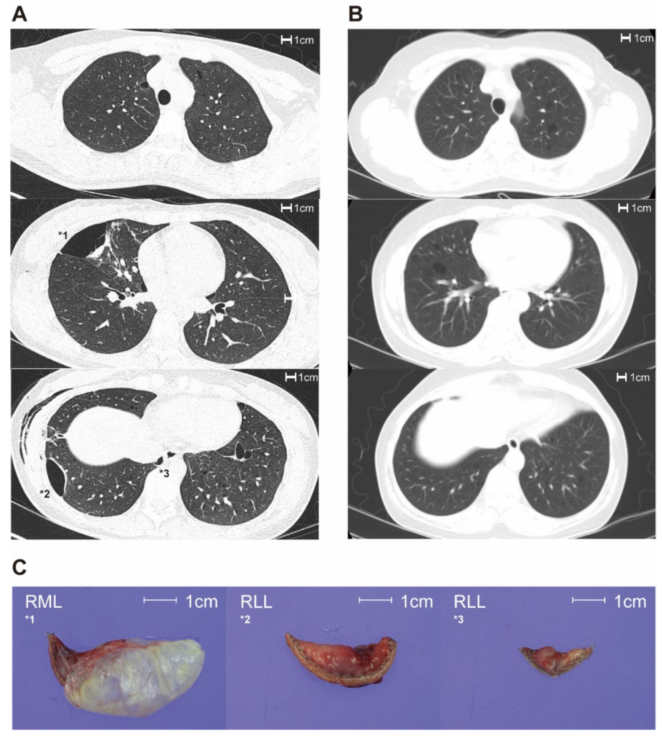 Diagnostics | Free Full-Text | Characteristic Chest Computed Tomography  Findings for Birt&ndash;Hogg&ndash;Dube Syndrome Indicating Requirement for  Genetic Evaluation