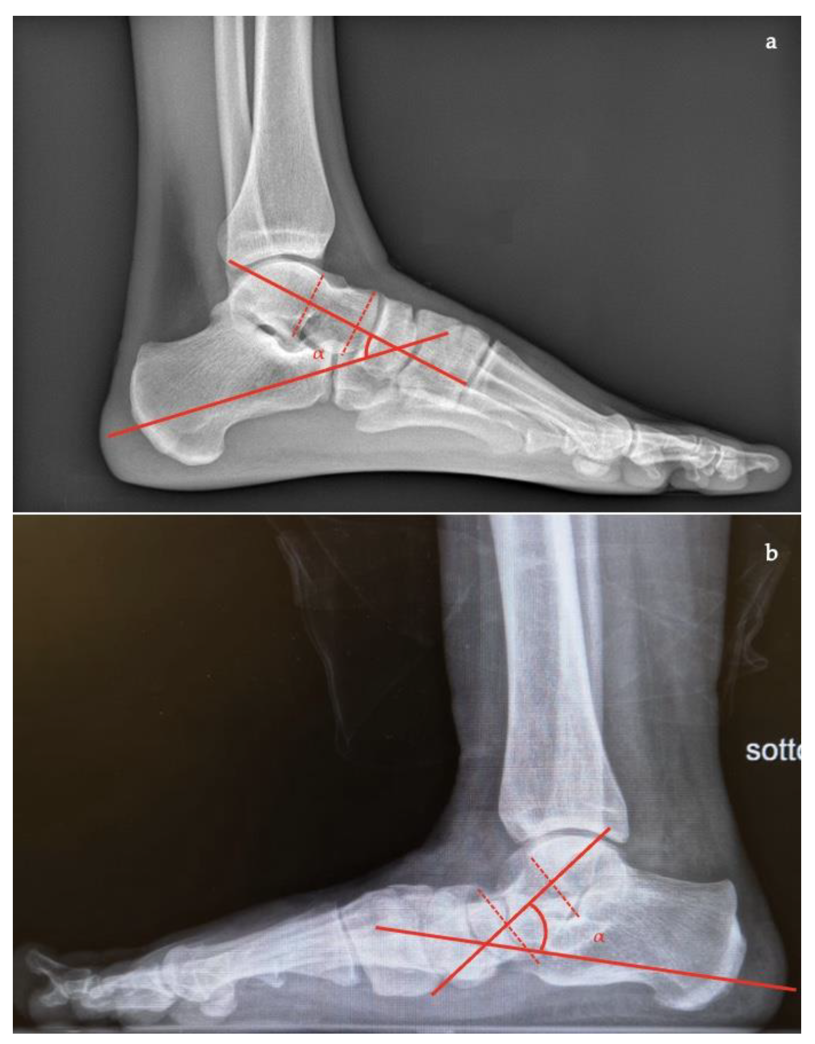 Distal phalanx of left fifth toe | BioDigital Anatomy