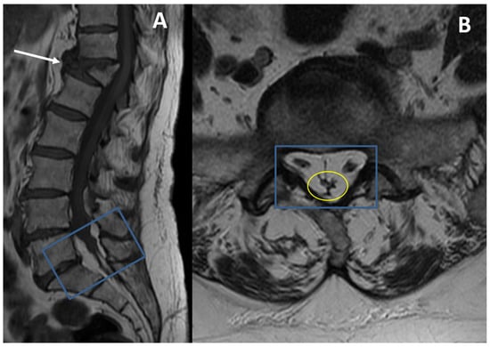 Diagnostics Free Full Text Could Spinal Epidural Lipomatosis Be The Hallmark Of Metabolic 0657