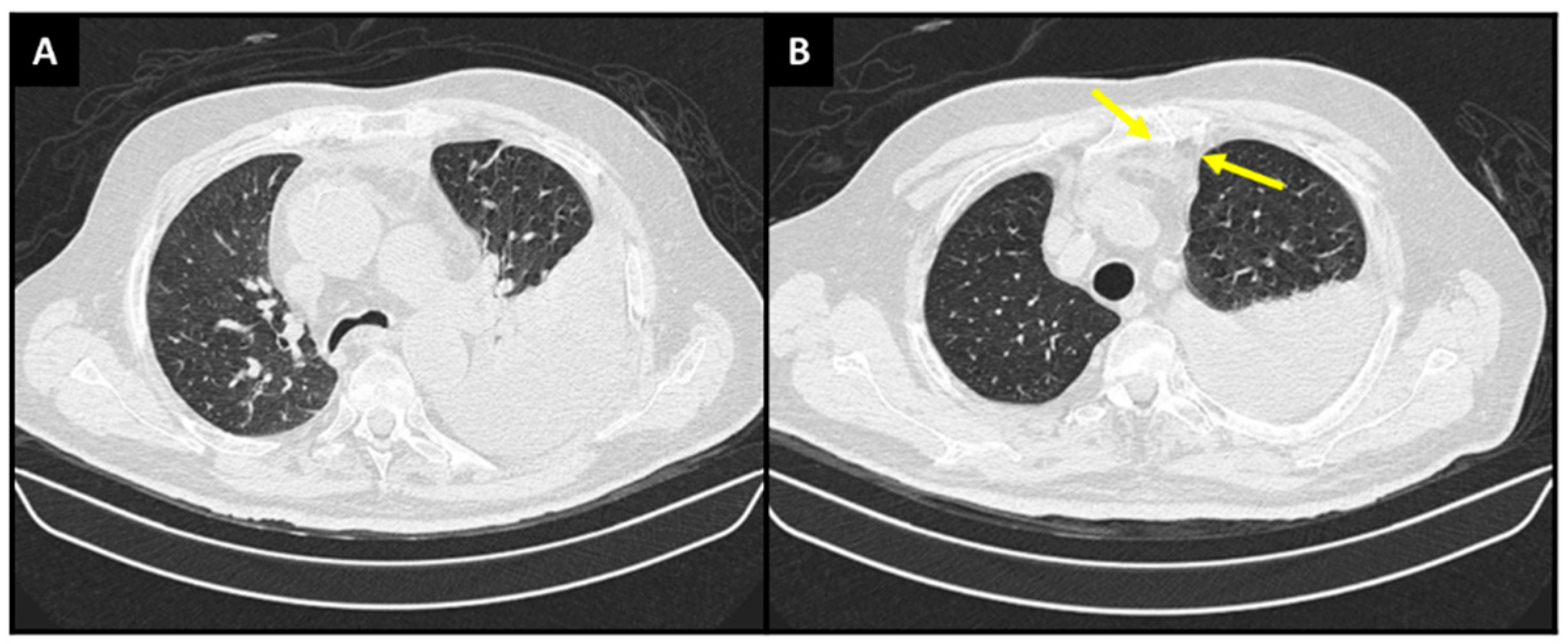 Diagnostics Free Full Text Primary Effusion Lymphoma A Rare And Challenging Diagnosis For 6142