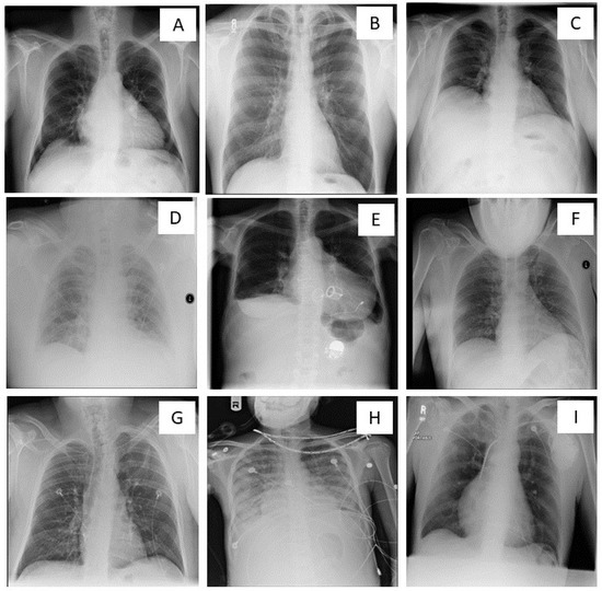 Diagnostics Free FullText Suboptimal Chest Radiography and