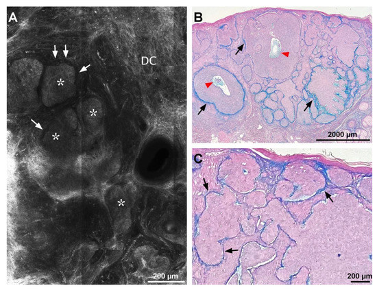 In Vivo Characterization Of Mucin And Amyloid Deposits In Primary Basal ...