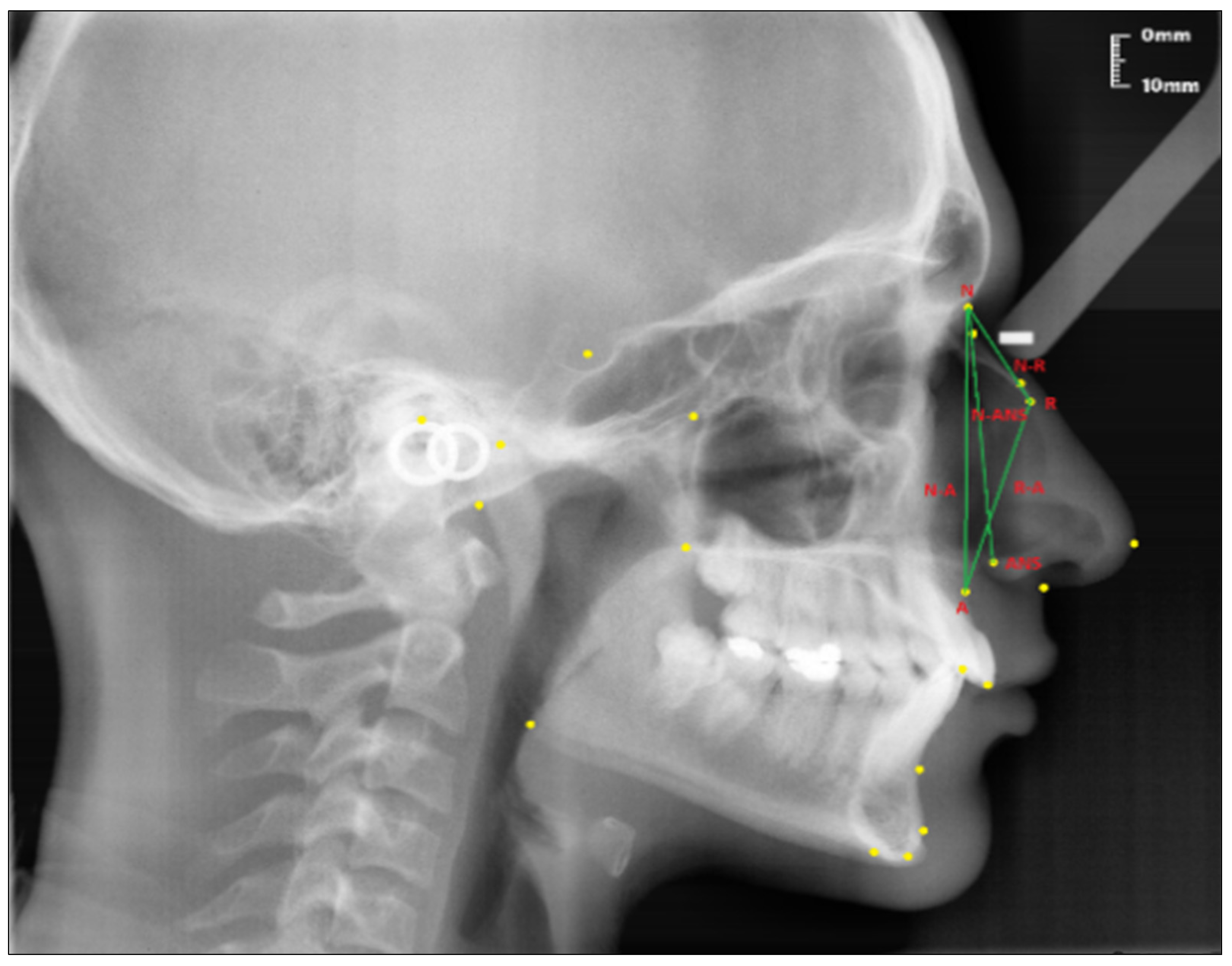 Diagnostics Free Full Text Investigation Of The Relationship Between Sagittal Skeletal Nasal