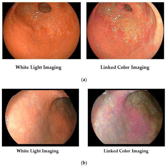 Diagnostics | Free Full-Text | Linked Color Imaging for Stomach