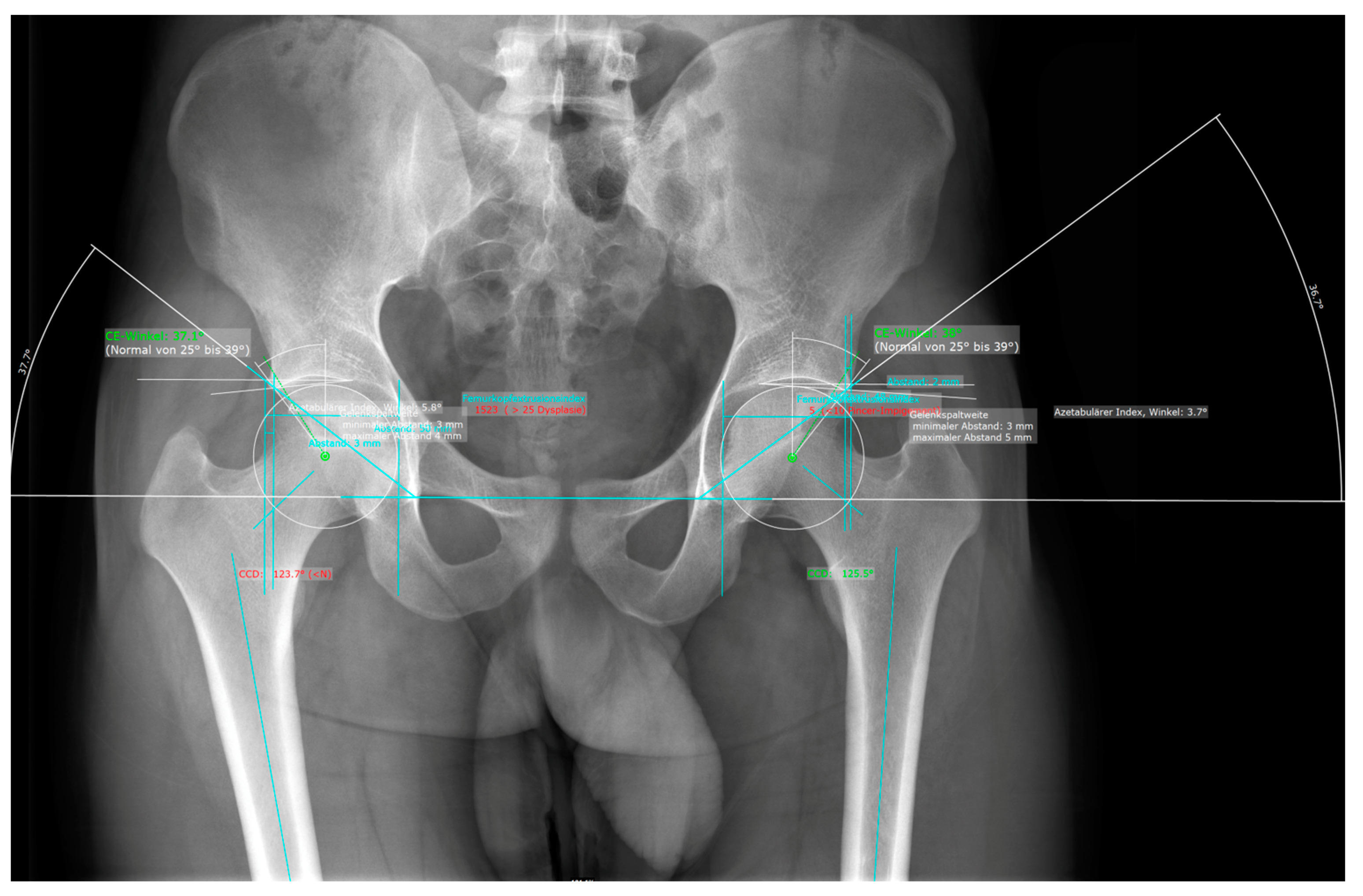 Diagnostics | Free Full-Text | Deep Learning for Fully Automated  Radiographic Measurements of the Pelvis and Hip