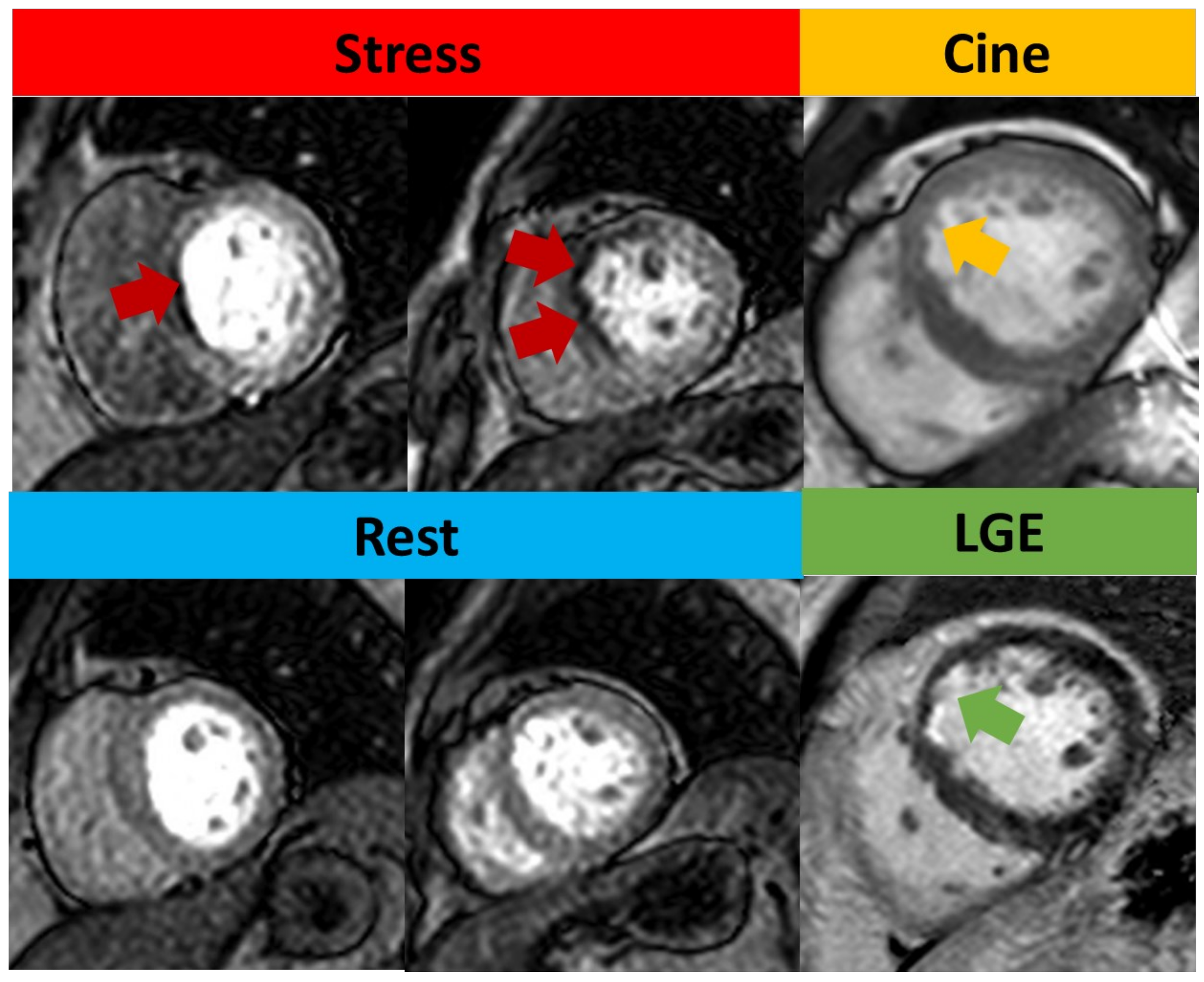 MRI study rest and stress perfusion in a 52 year old male with stable   Download Scientific Diagram