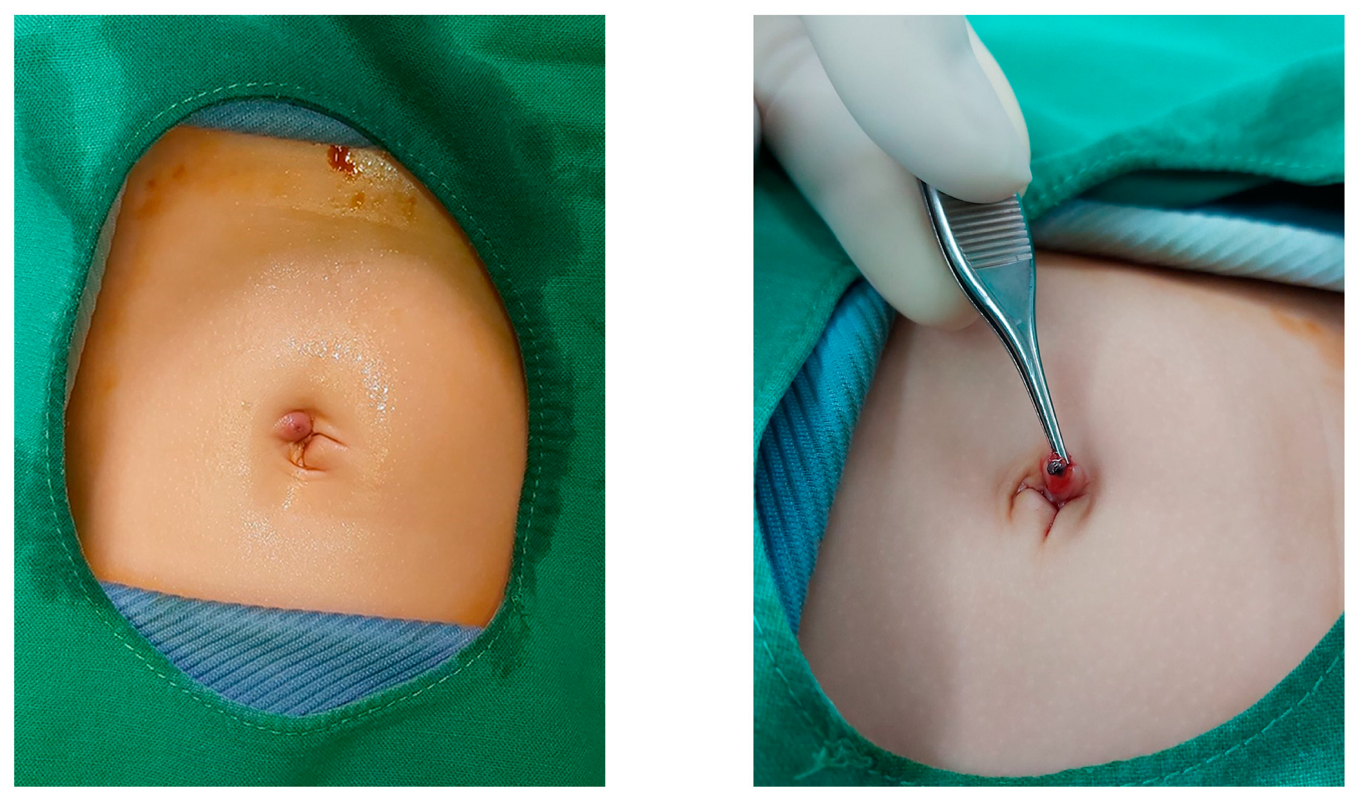 Needlescopic surgery for large umbilical hernia in a patient with