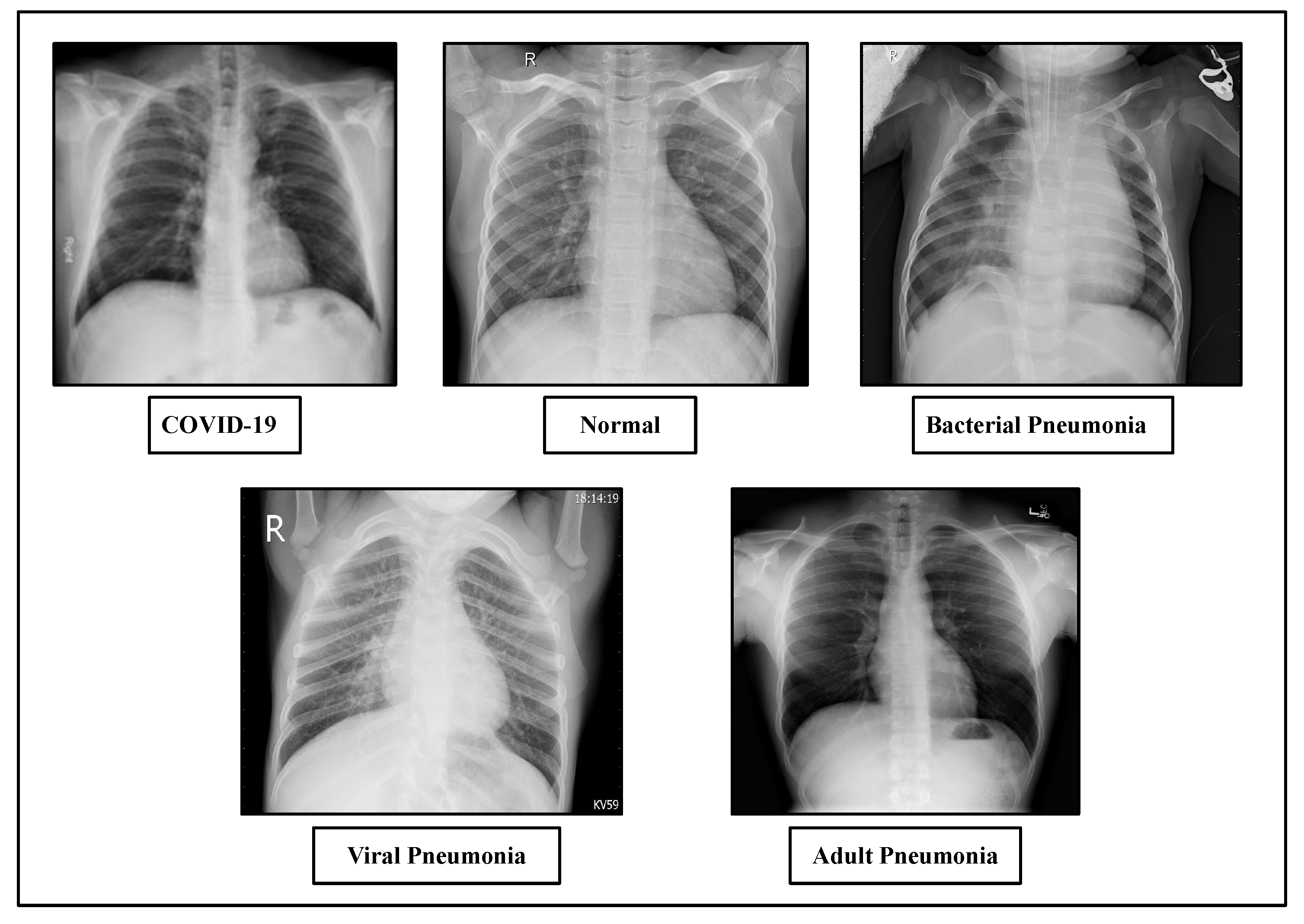 viral pneumonia case study ppt