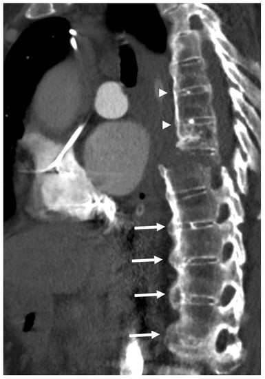 X-ray thoracic spine showing hyperostosis (arrows) involving left half