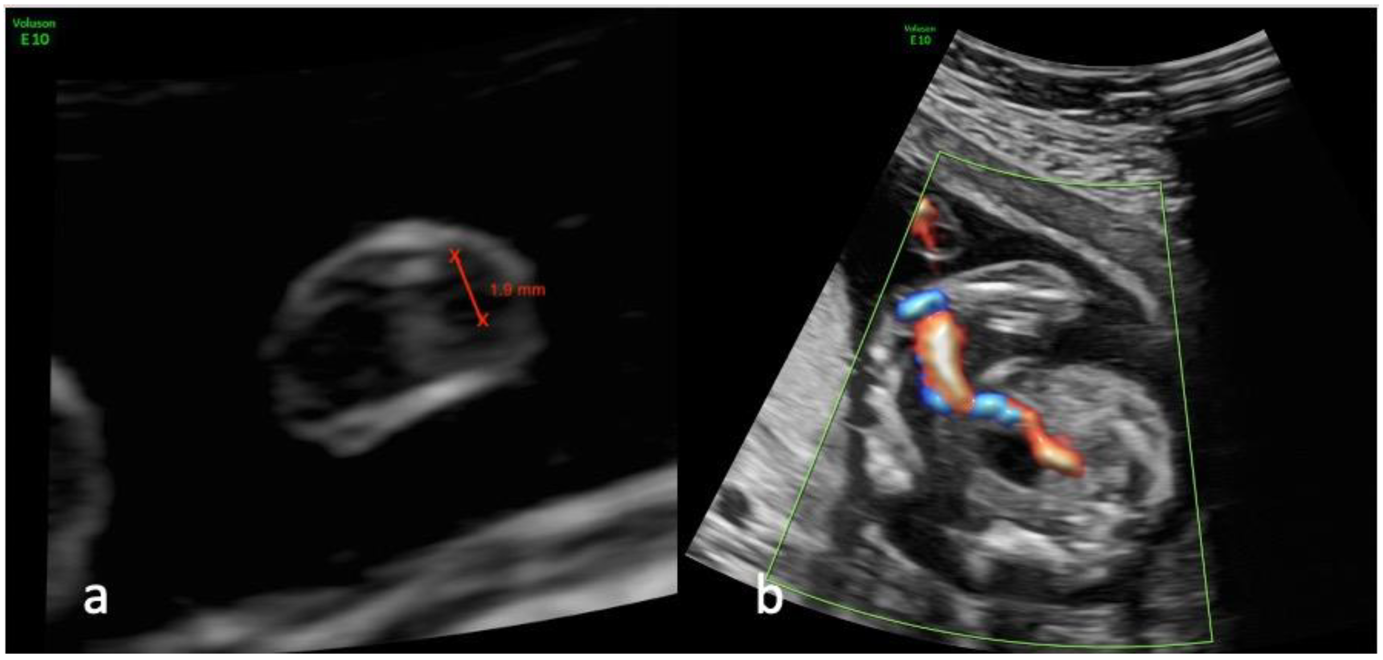 Diagnostics | Free Full-Text | Changes in Artery Diameters and Fetal Growth  in Cases of Isolated Single Umbilical Artery