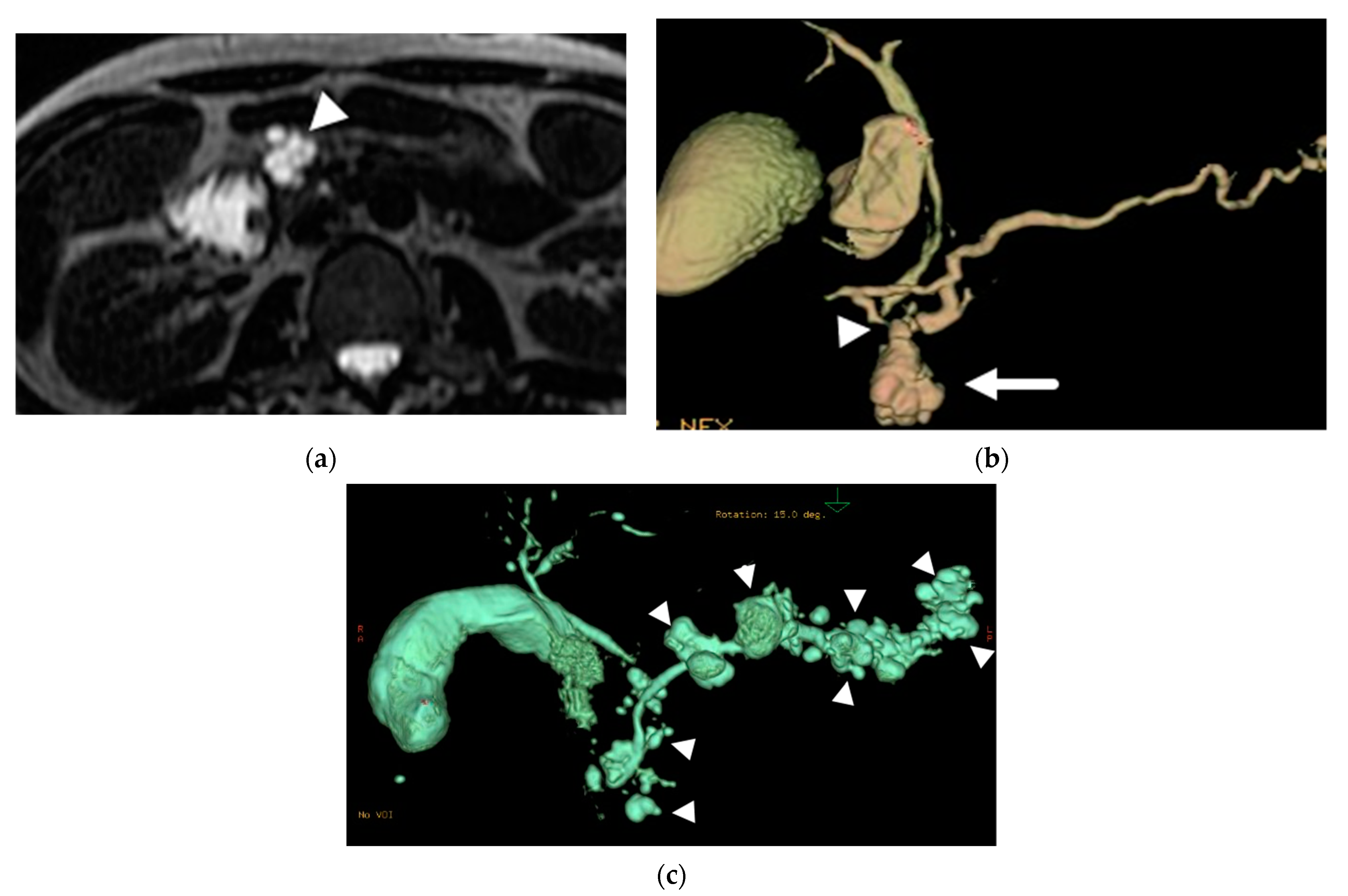 Diagnostics | Free Full-Text | The Role of Magnetic Resonance Imaging (MRI)  in the Diagnosis of Pancreatic Cystic Lesions (PCLs)