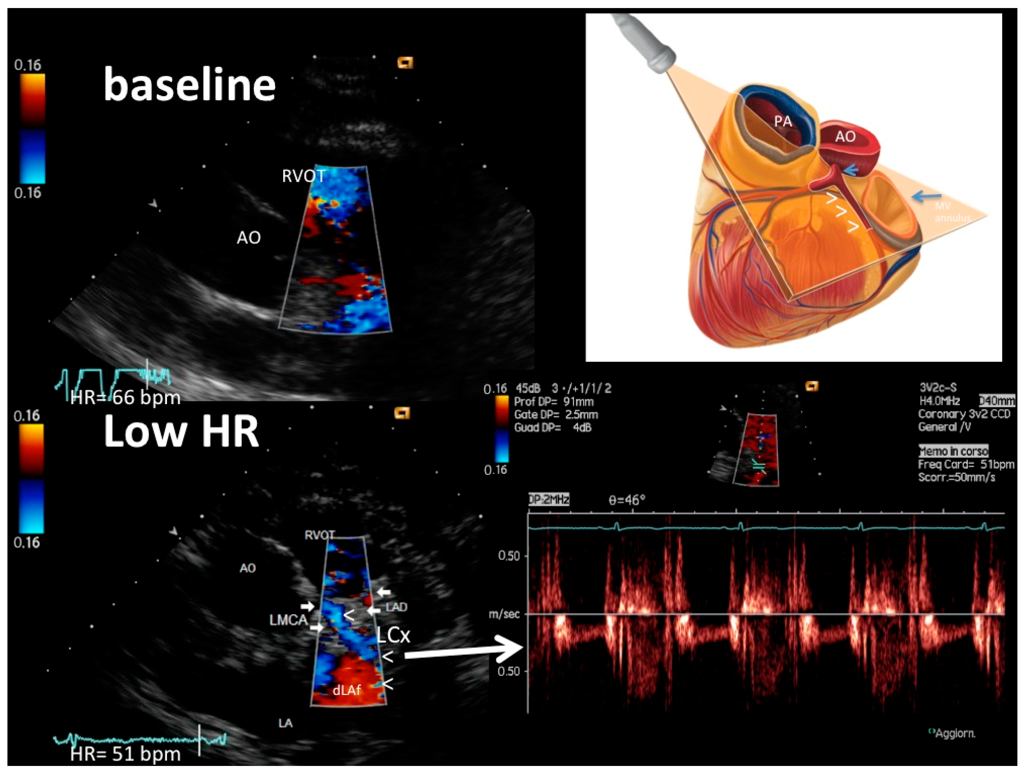 EchoHeart Summit Doppler