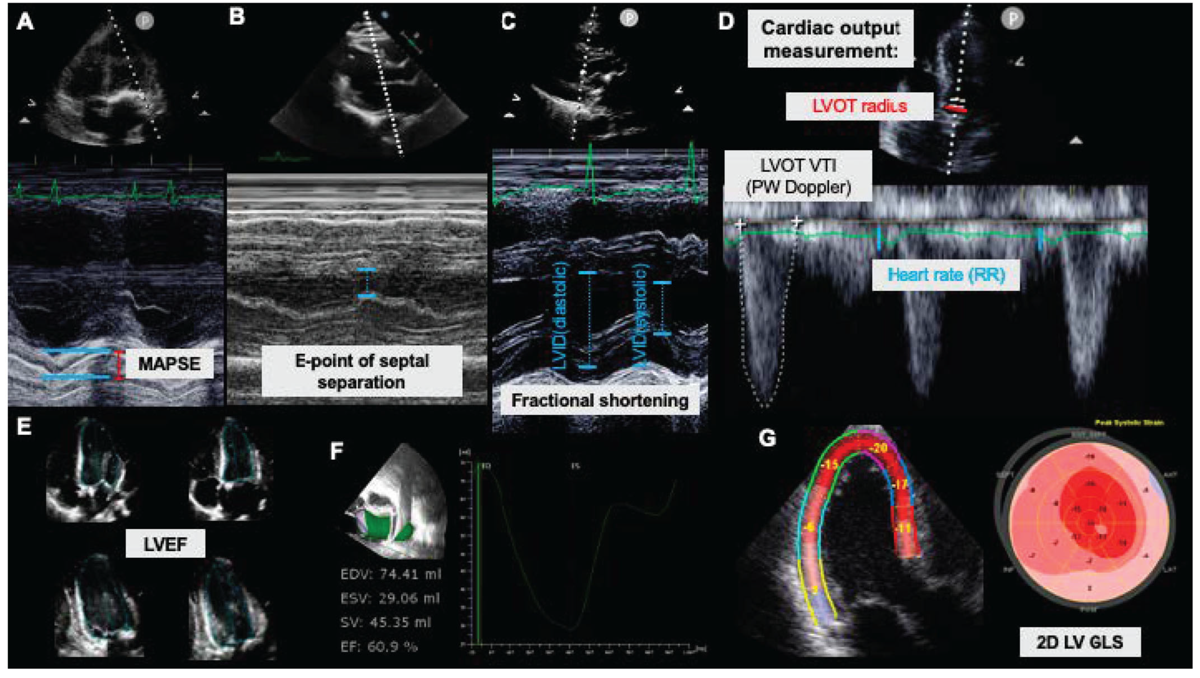 M-Mode Echocardiography and 2D Cardiac Measurements*