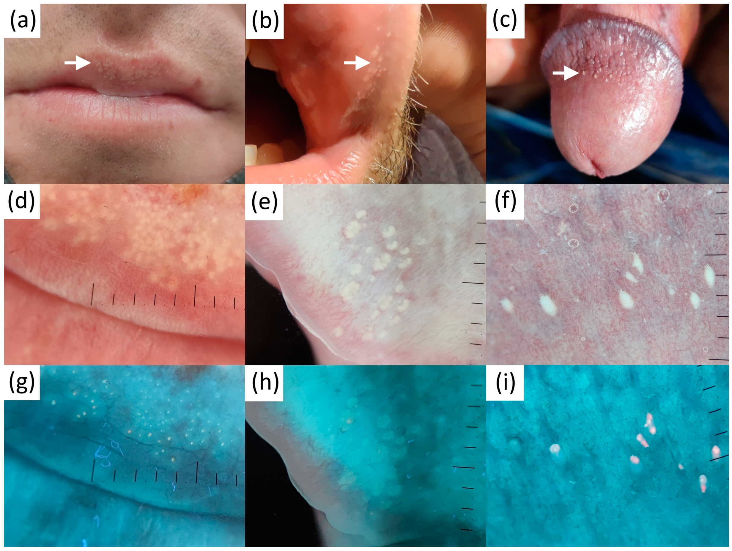 Diagnostics | Free Full-Text | Differentiating Fordyce Spots from Their  Common Simulators Using Ultraviolet-Induced Fluorescence  Dermatoscopy&mdash;Retrospective Study