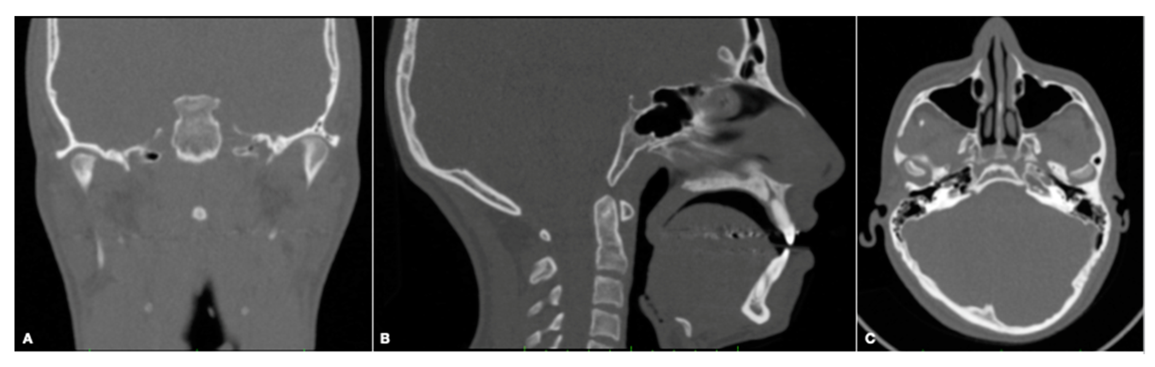 PDF] Evaluation of horizontal condylar angle in malocclusions with  mandibular lateral displacement using cone-beam computed tomography.