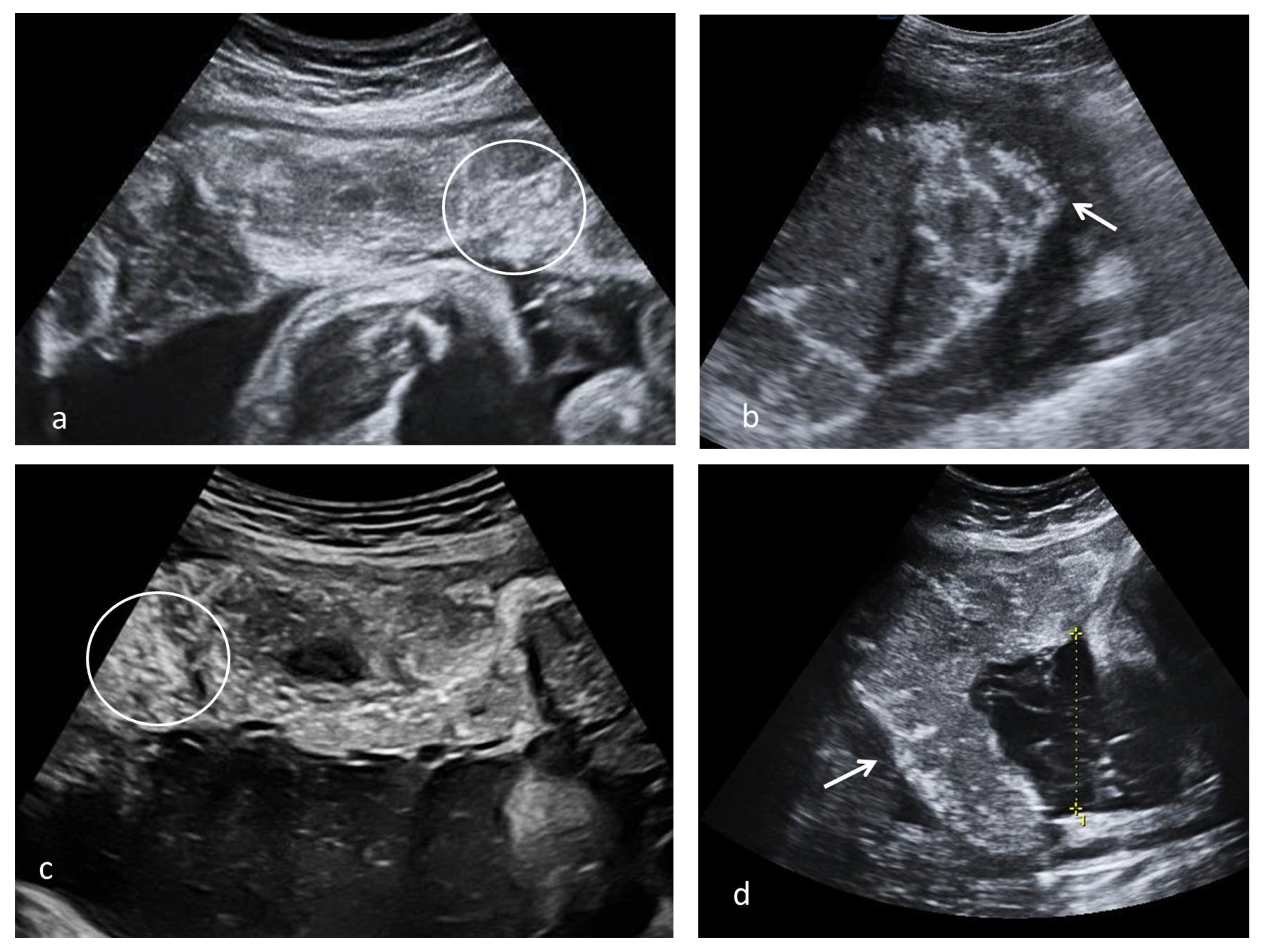 circummarginate placenta ultrasound