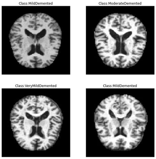 Accurate Detection Of Alzheimers Disease Using Lightweight Deep Learning Model On Mri Data 1943