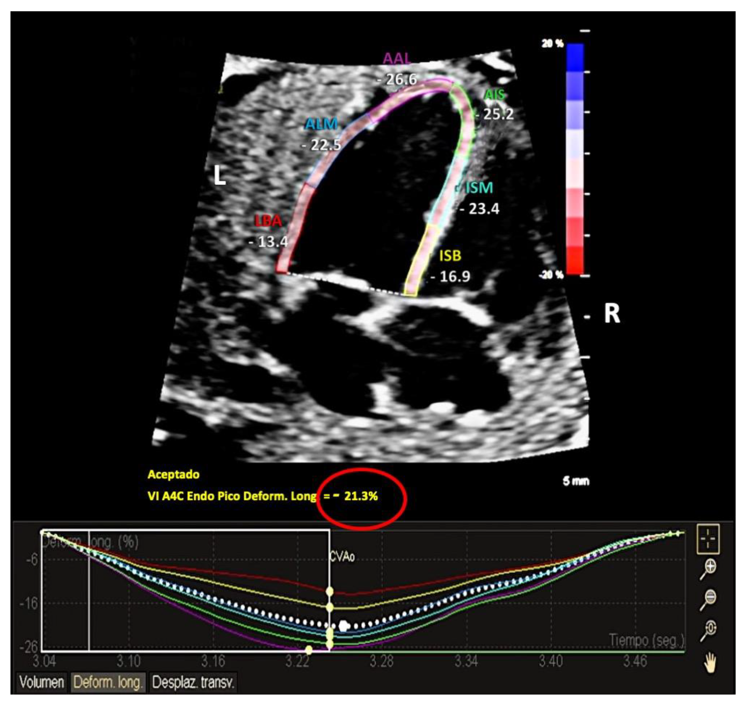 Figure 4. [Global longitudinal strain by speckle]. - Endotext - NCBI  Bookshelf