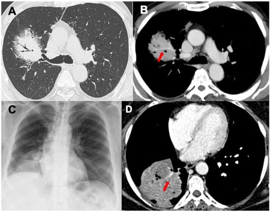 Diagnostics | Free Full-Text | Primary Lymphoproliferative Lung ...