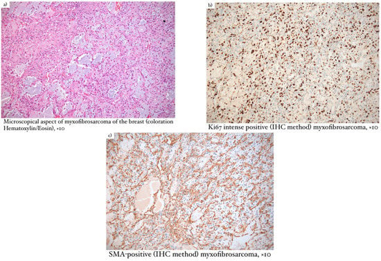 Diagnostics | Free Full-Text | Breast Sarcomas—How Different Are They ...