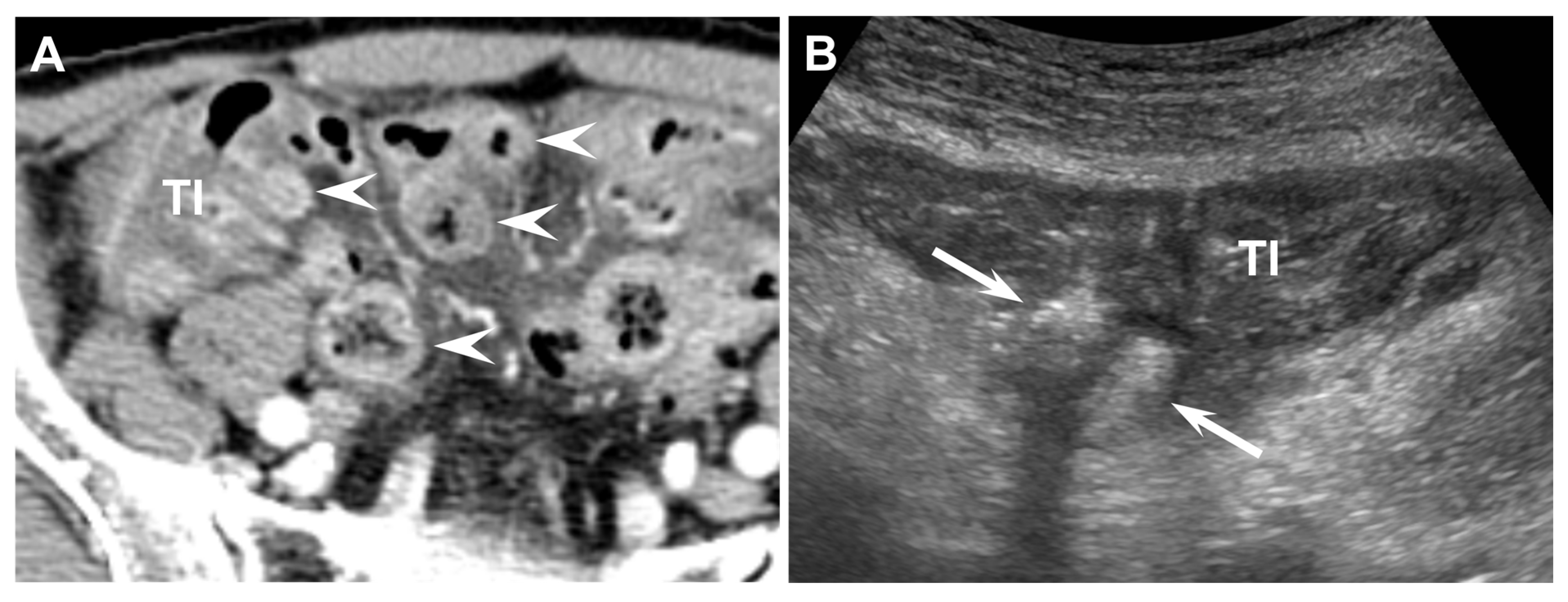 Diagnostics Free Full Text Acute Ileal Diverticulitis Computed Tomography And Ultrasound