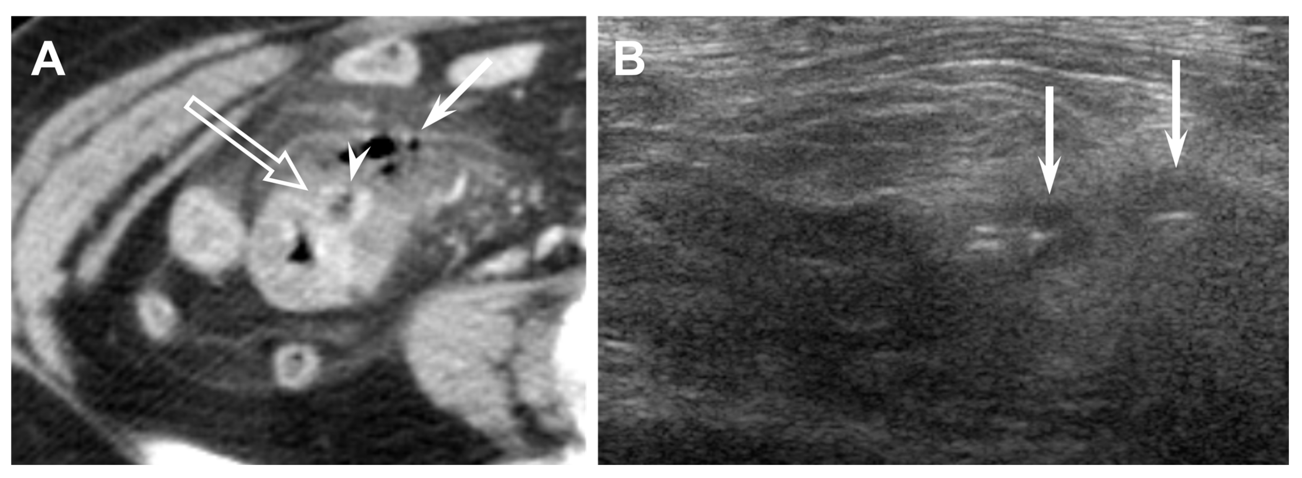 Diagnostics Free Full Text Acute Ileal Diverticulitis Computed Tomography And Ultrasound 2036