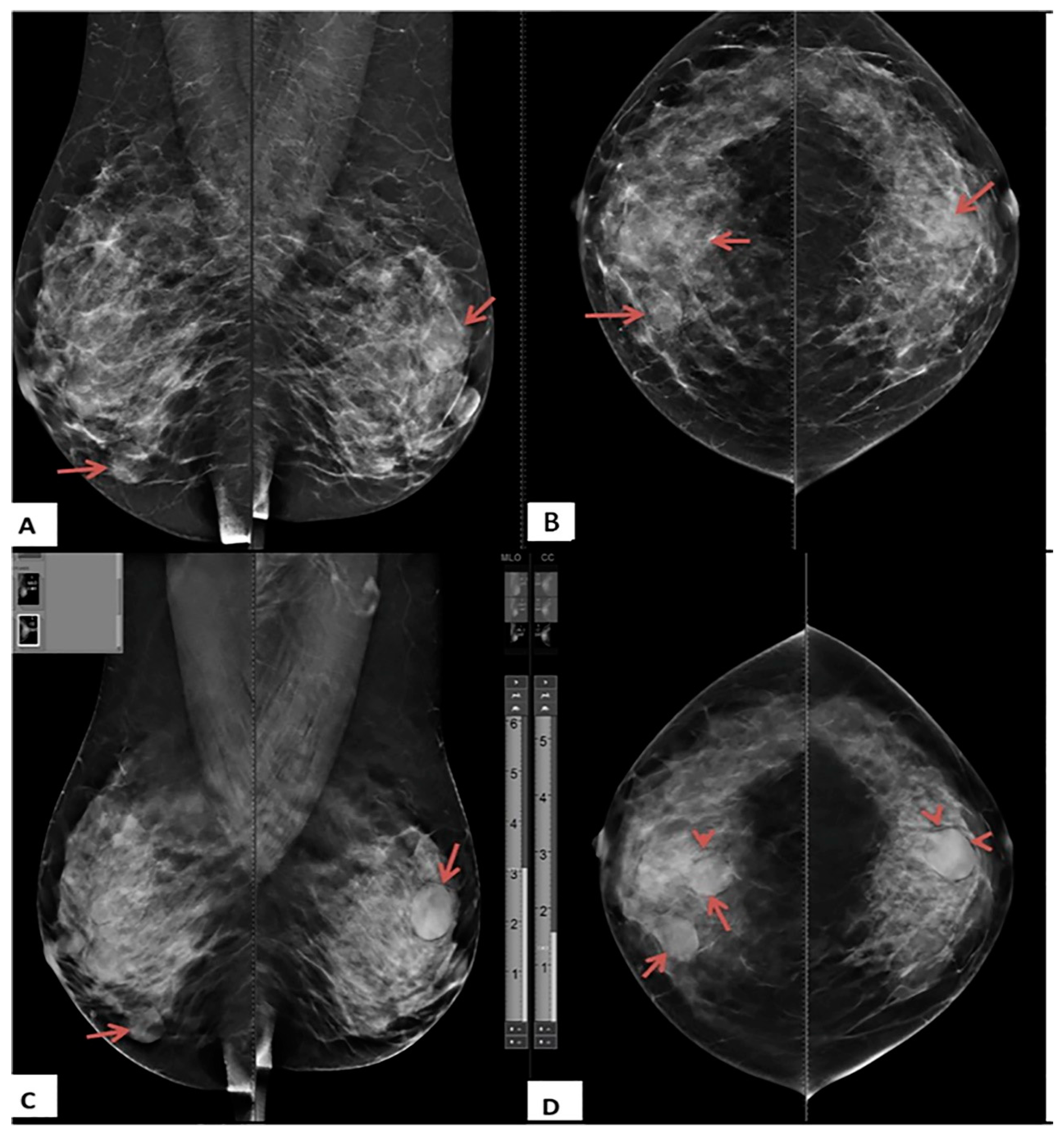Study of role of digital breast tomosynthesis over digital
