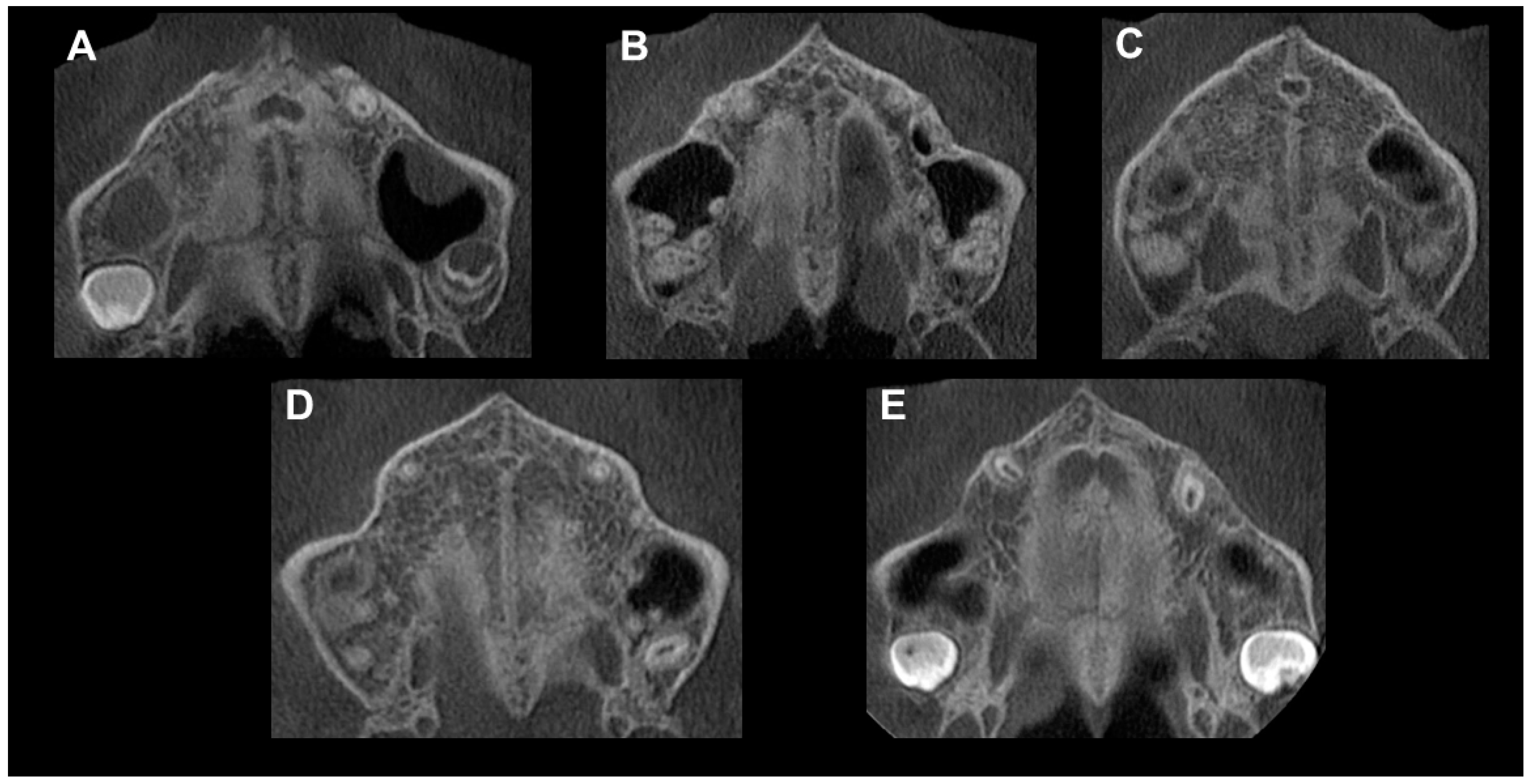 Diagnostics | Free Full-Text | Midpalatal Suture Maturation Stage in 10 ...