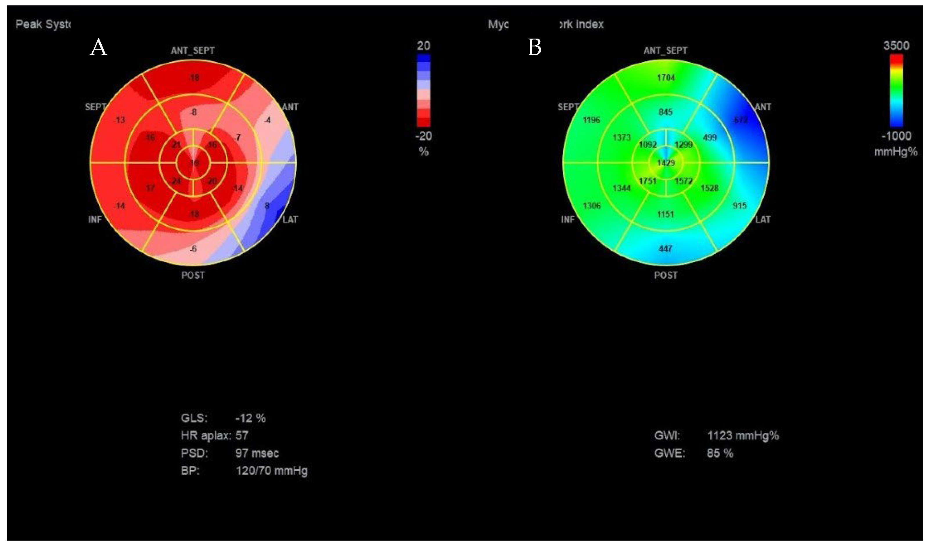 Practical assessment of myocardial work. a Global longitudinal strain