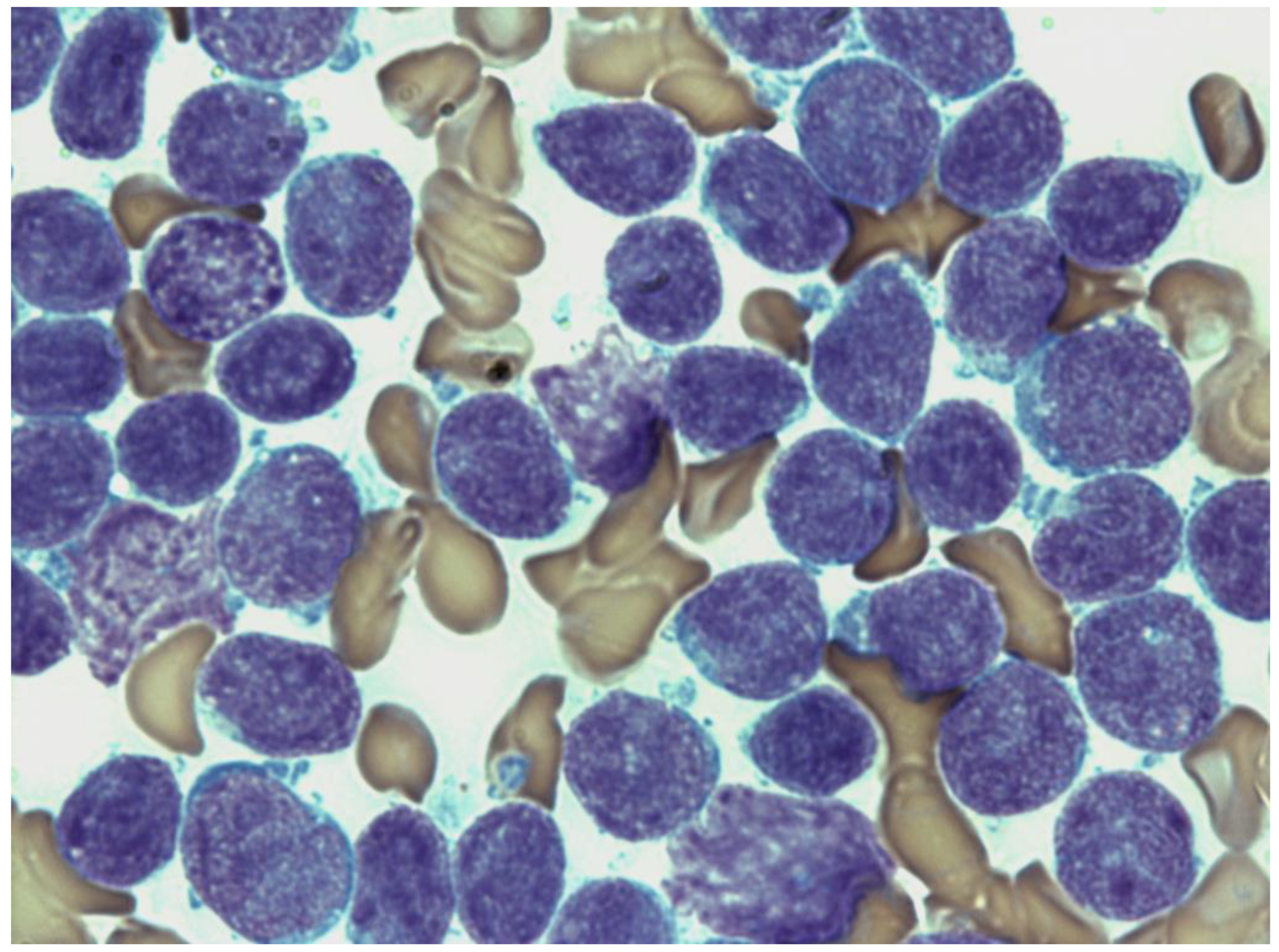 acute lymphoblastic leukemia bone marrow biopsy