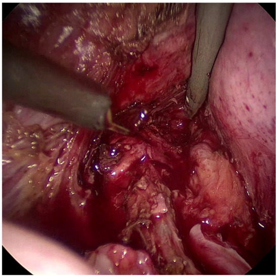 Vaginal mass with necrotic appearance obstructing the vaginal introitus.