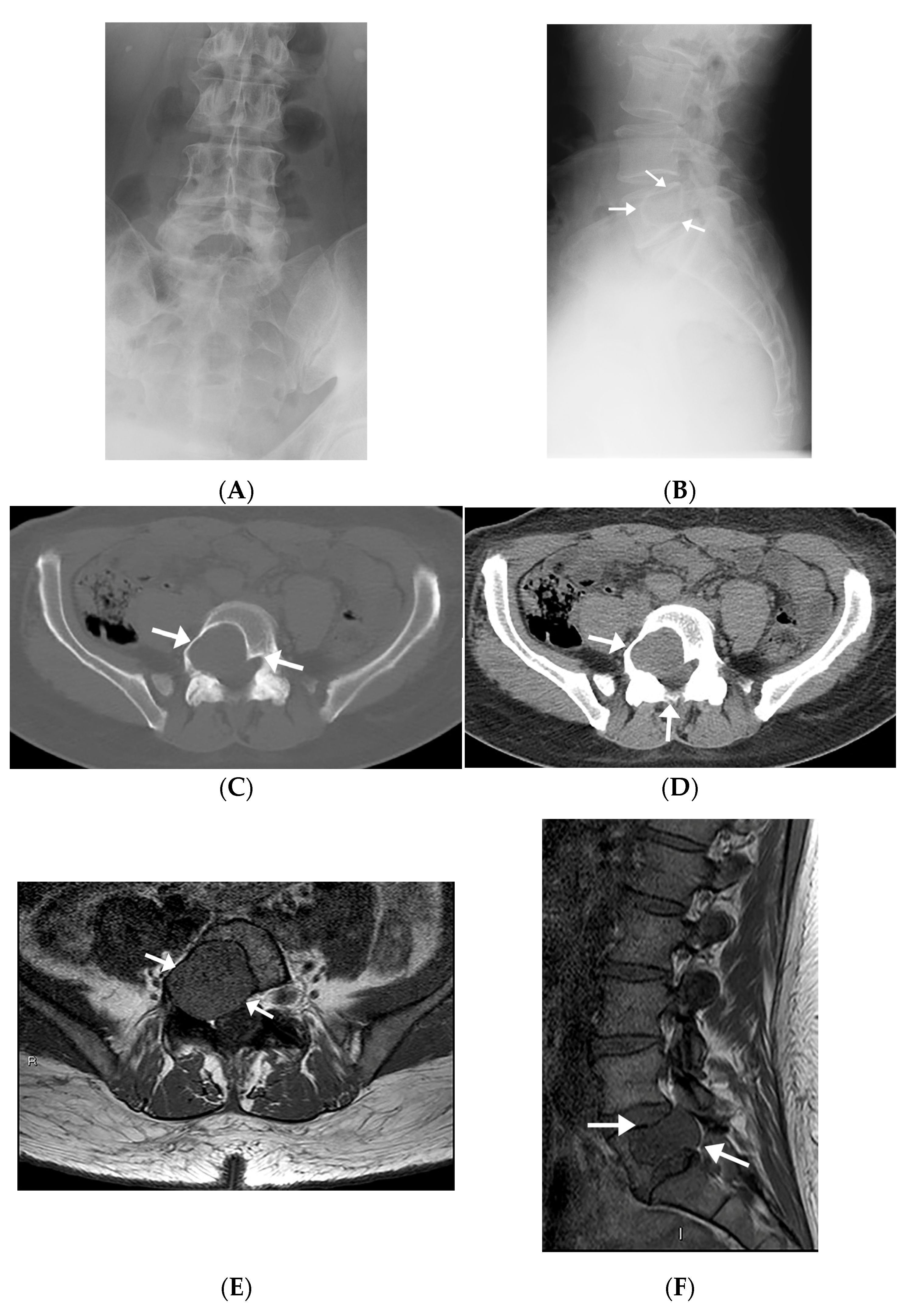 MRI of the dorso-lumbar spine showing a partial collapse of the D12