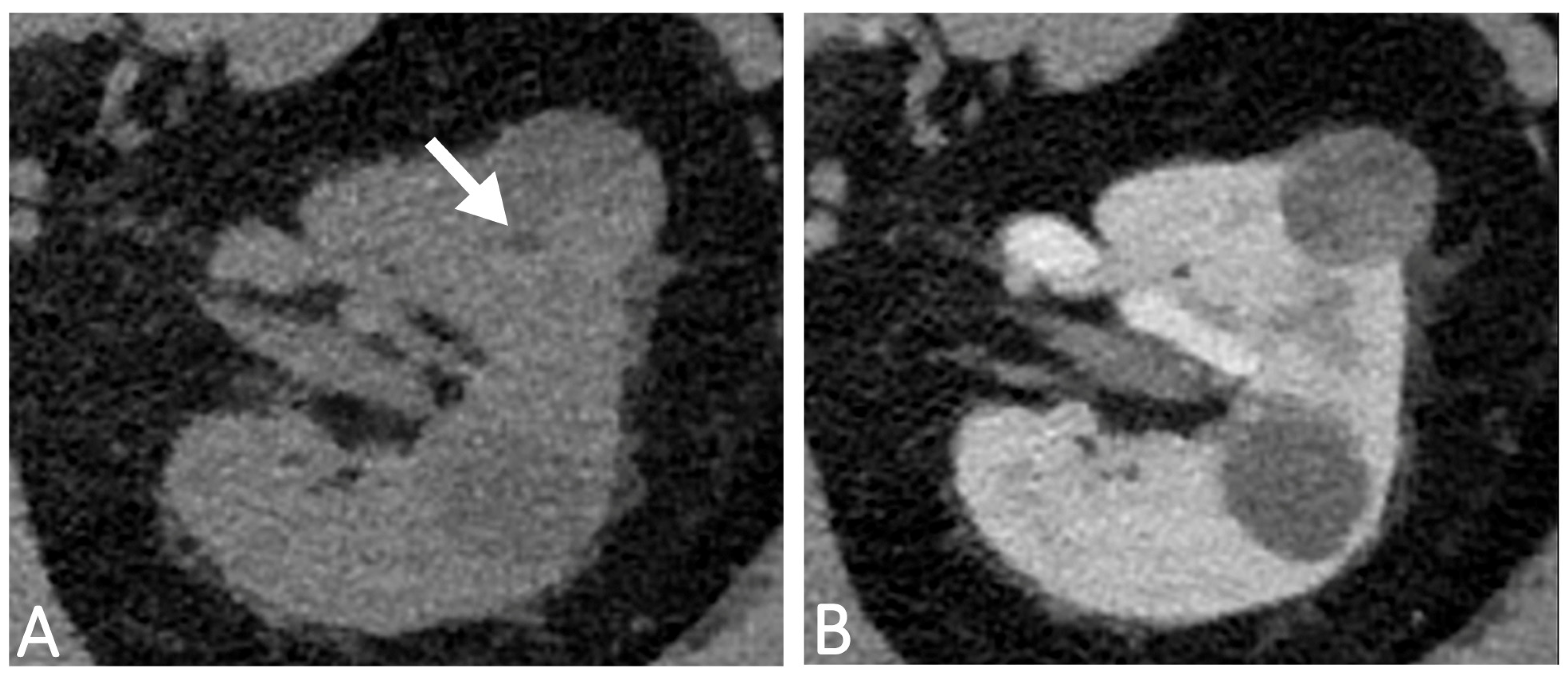 Diagnostics | Free Full-Text | Minimal Fat Content in Papillary Renal ...