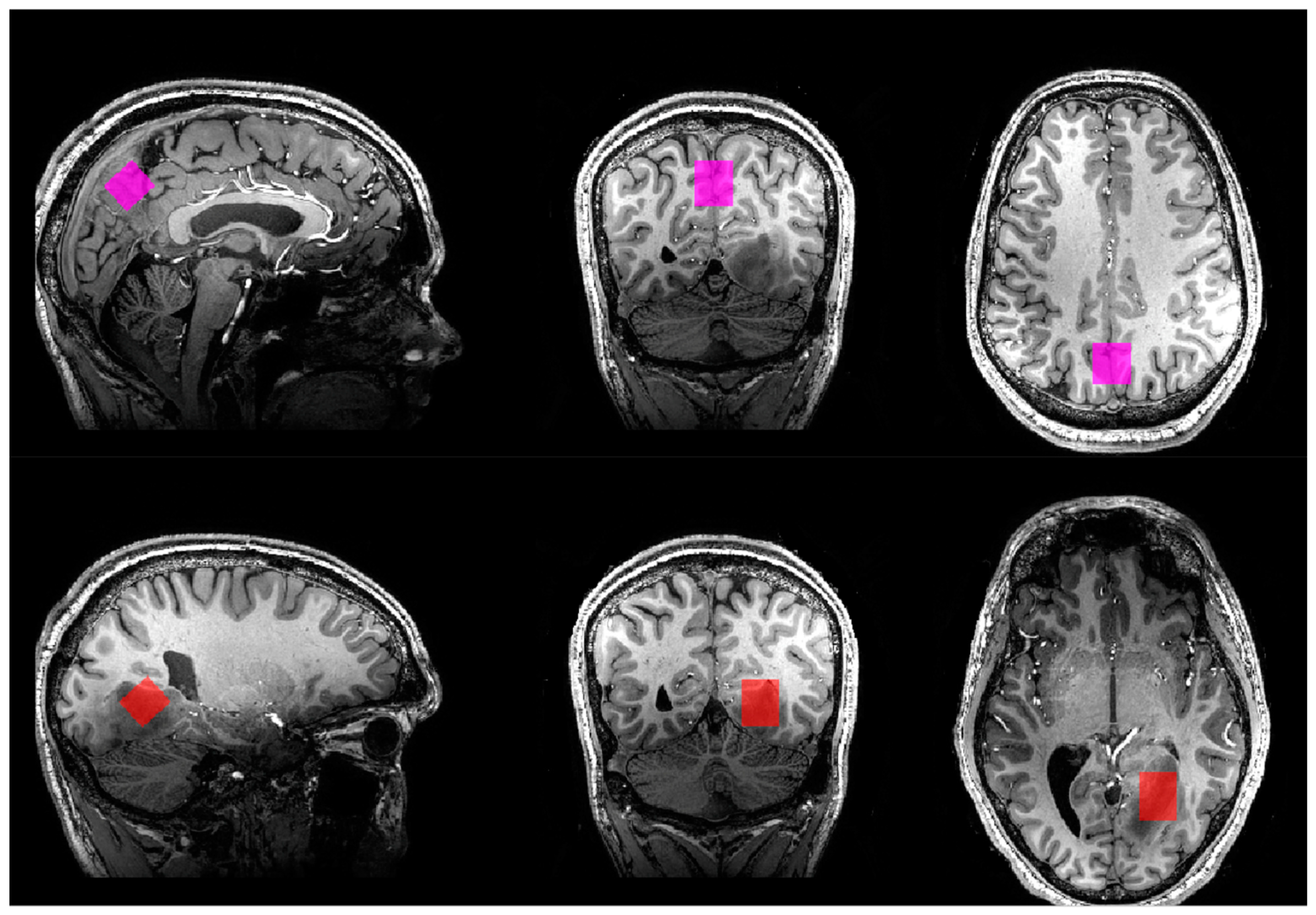 Diagnostics Free Full Text Single Voxel MR Spectroscopy of