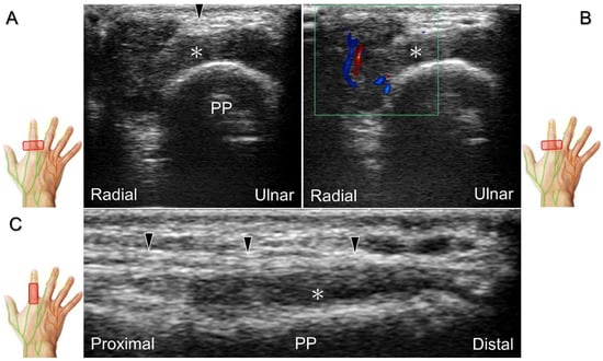 Cureus, Sequelae of a Rare Case of Penetrating Parotid Gland Injury:  Ultrasound and Magnetic Resonance Imaging Features