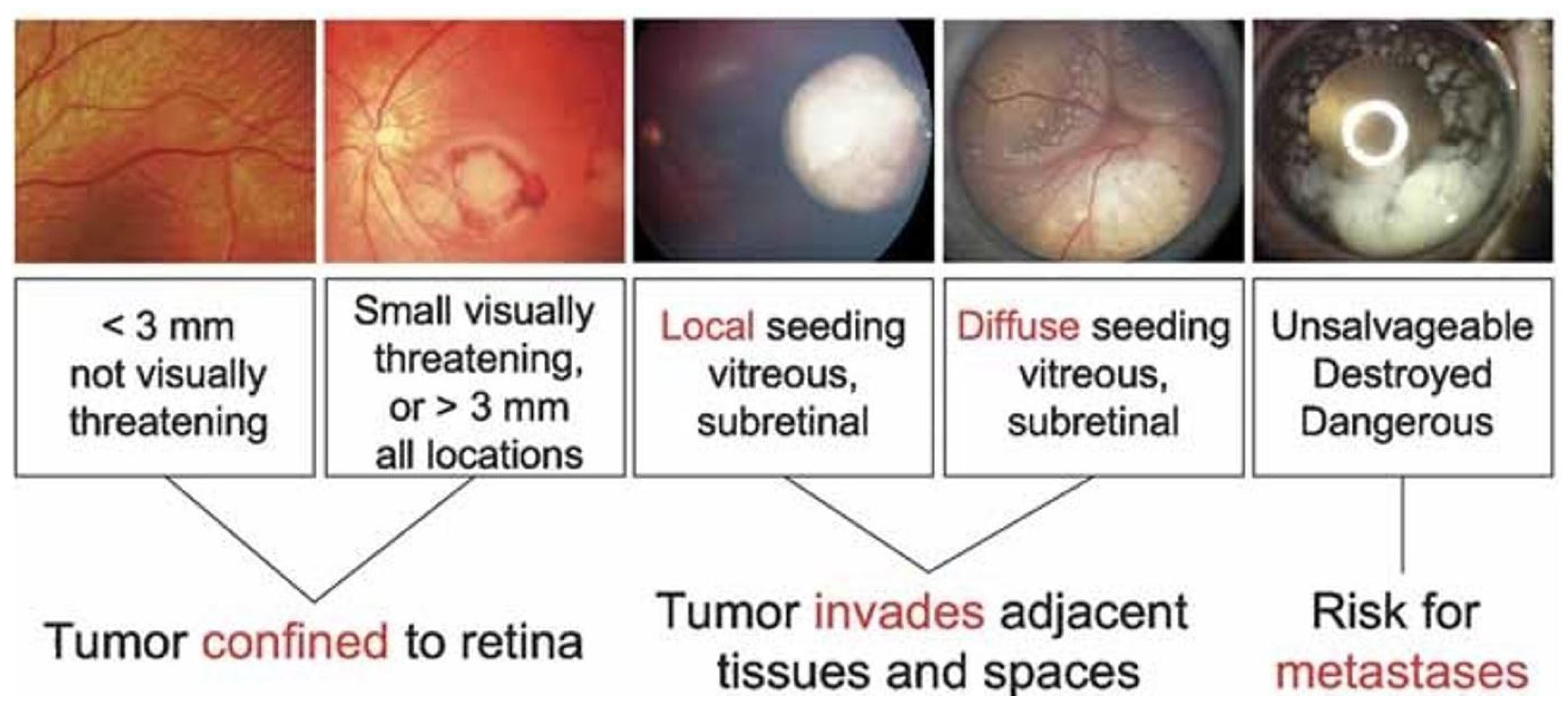 Diagnostics Free FullText Explainable AI for Retinoblastoma