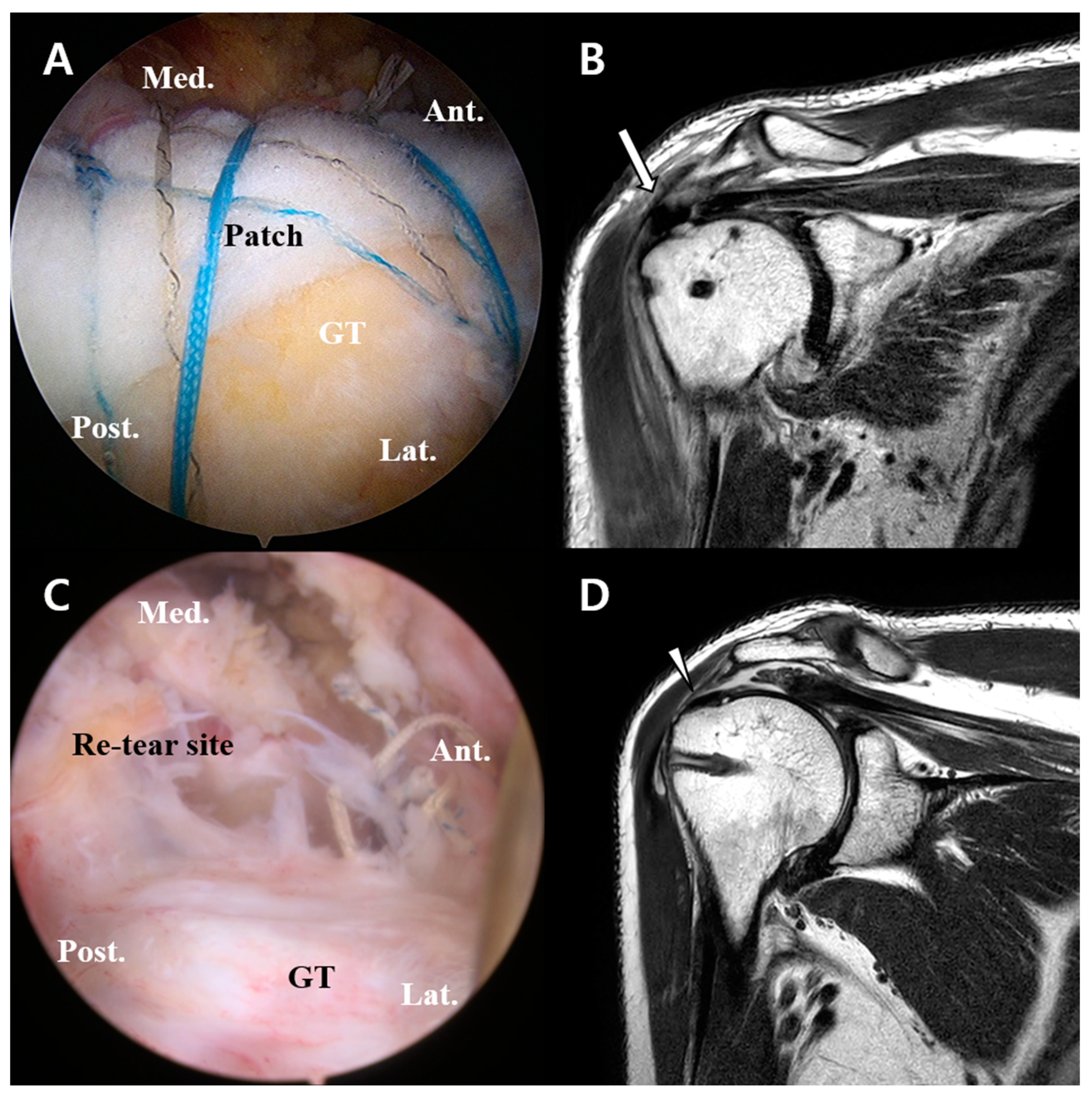 Arthroscopic view of the rotator cuff repair. Picture a shows the large