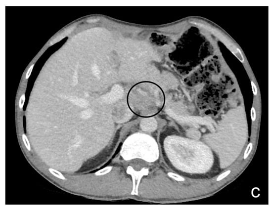 The Radiology Assistant : Acute Abdomen in Gynaecology - Ultrasound