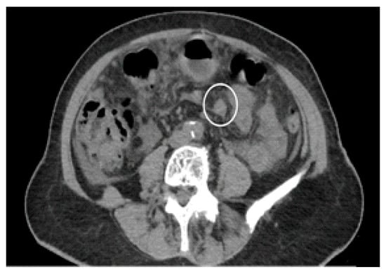 Diagnostics | Free Full-Text | Peritoneal Carcinosis: What the Radiologist  Needs to Know