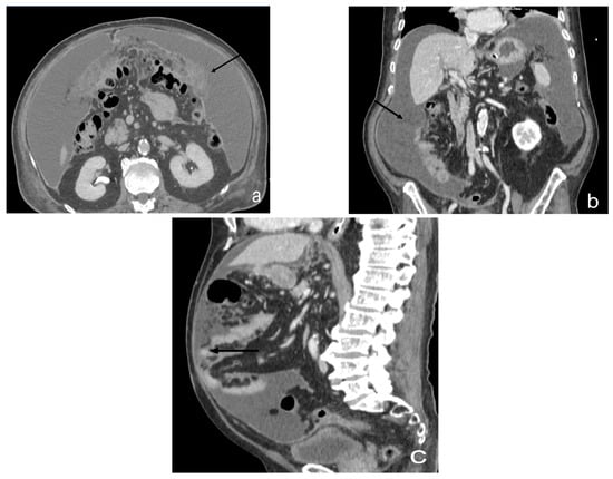 CT and MR imaging of the greater omentum: Pictorial essay