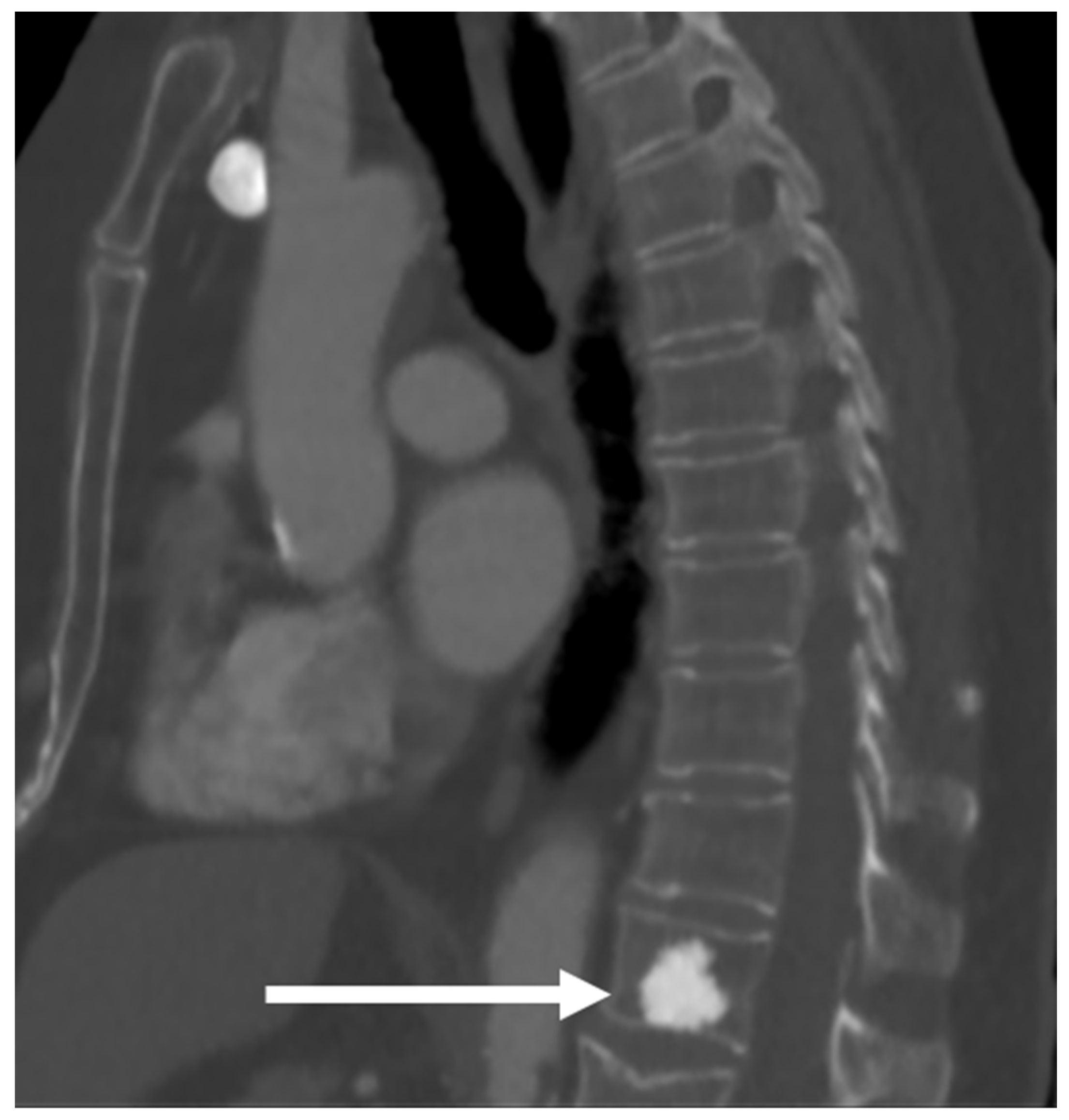 Hereditary multiple exostoses with spinal cord compression.