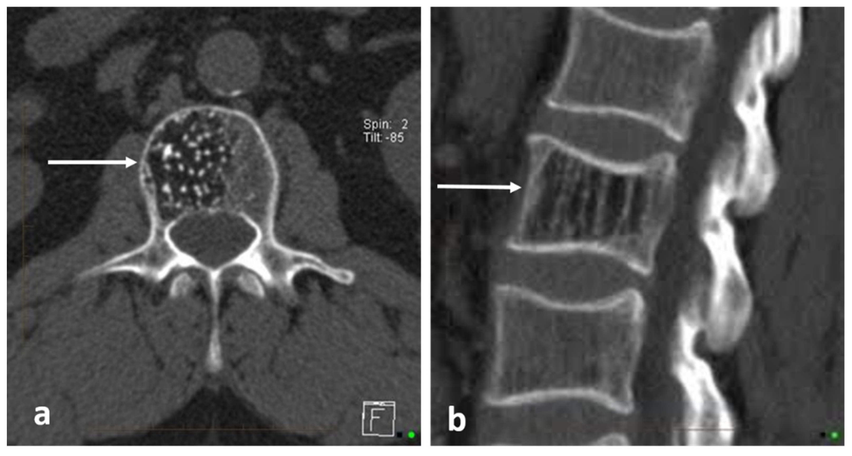 Diagnostics | Free Full-Text | Primary Benign Neoplasms of the Spine