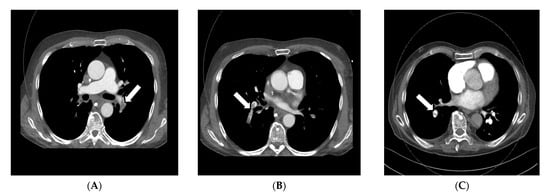 Frontiers  Dual-energy computed tomography to detect early