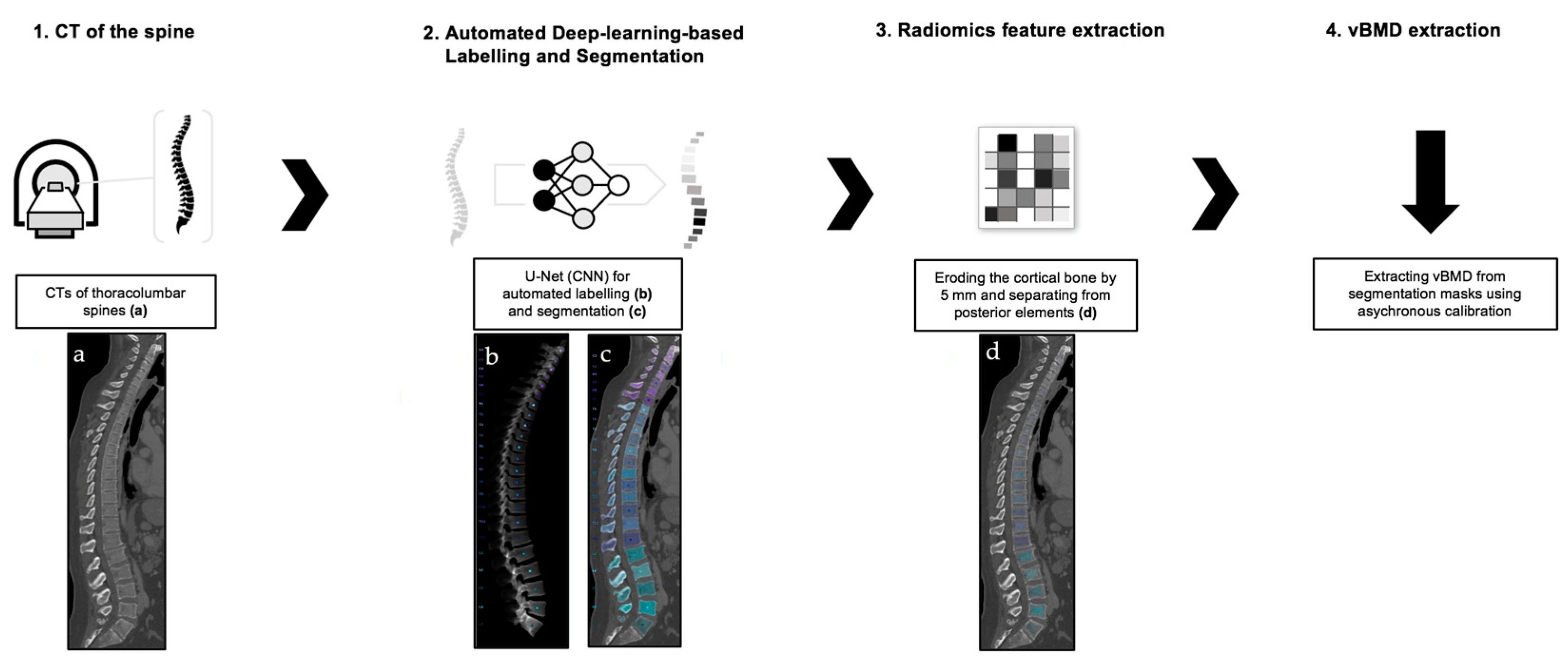 Semiquantitative (SQ) visual grading scheme for vertebral fractures.