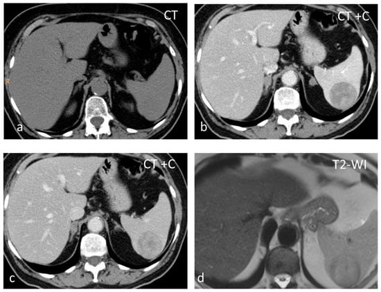 Diagnostics Free Full Text The Spectrum Of Solitary Benign Splenic Lesions—imaging Clues For