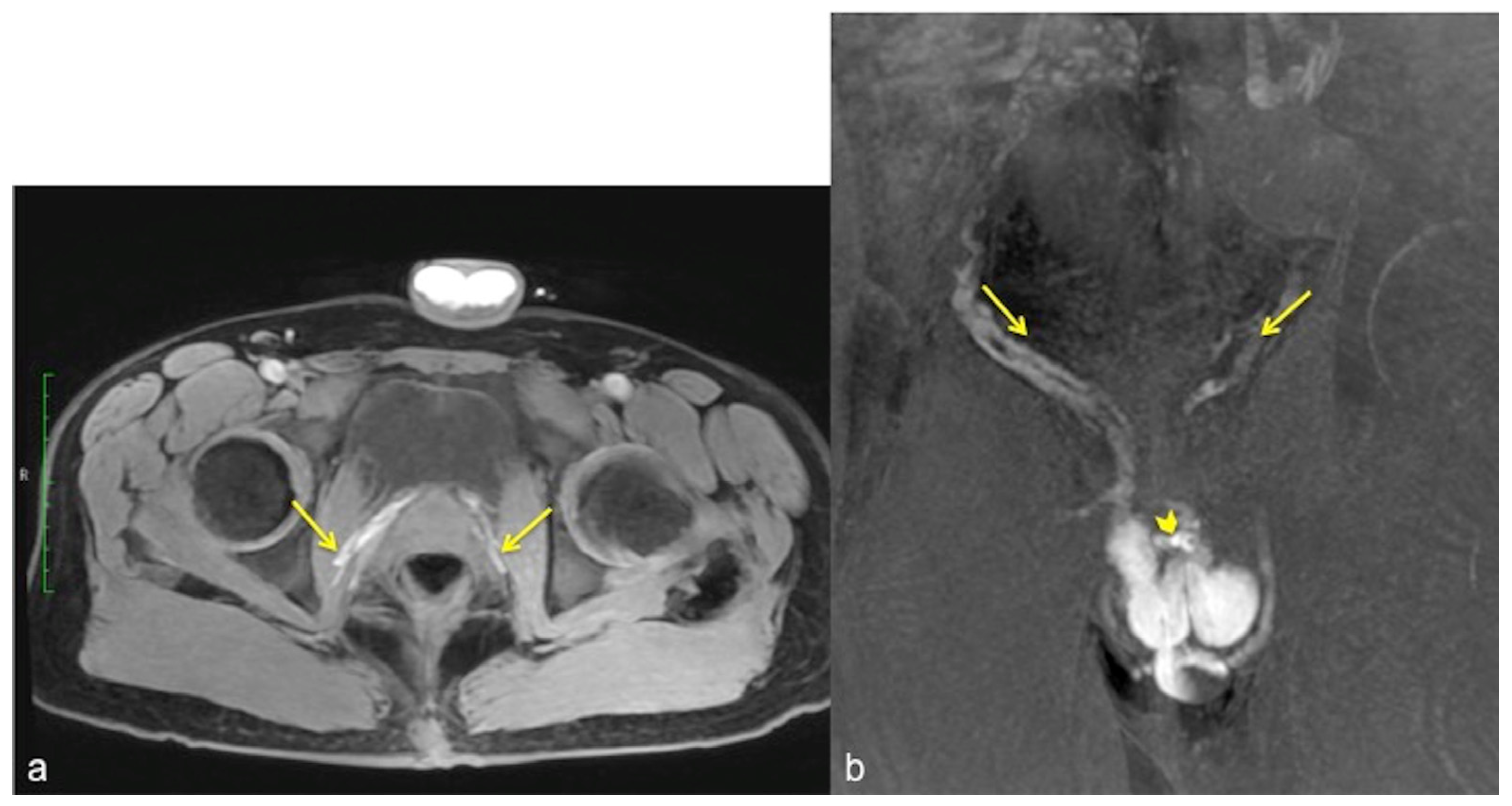 Diagnostics | Free Full-Text | MRI-Cavernosography: A New Diagnostic ...